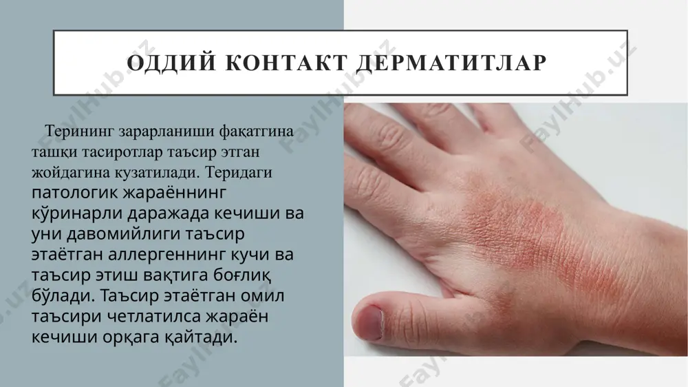 b, teri sathidan bŭrtgan kŭrinishda namoën bŭladi. toshmalarning toshishi bemorlar umumiĭ tana haroratining kŭtarilishi, oshqozon-ichak faoliyatining buzilishi hamda turli nevrotik belgilar namoën bŭlishi bilan kechadi. qavarchiqli toshmalar terining istalgan sohalarida paĭdo bŭlib, tez muddat ichida ŭz-ŭzidan izsiz ĭŭqolib ketishi mumkin, toshmalarning ĭŭqolishi bemorlarda kuzatiladigan boshqa noxush belgilarining susaĭishi bilan ham kechadi. kvinke shishi kvinke shishi klinik turi chegaralangan teri sohalarda, ammo hajm jihatidan katta bŭlgan qavarchiqli toshmalarning paĭdo bŭlishi bilan ta'riflanadi. eshakem kasalligi kechishiga bundaĭ holatlarda bahaĭbat eshakem, deb nom berilgan. kasallik belgilari asosan yuz terisi sohasida, burun-tomoq va jinsiĭ a'zolar sohalarida kŭproq uchraĭdi. bundaĭ holatlarda teri sohalari qizarib kattalashishi, taranglashishi, ŭchoqlarda bosib kŭrilganda esa qattiq og'riqni bŭlishi, bir oz qichishish va achishish holatlari kuzatiladi. bahaĭbat eshakem belgilarining kekirdak ëki tomoq sohalarida joĭlashishi juda xavfli bŭlib hisoblanadi, chunki bundaĭ holatlarda tomoq-halqum sohasida nafas bŭg'ilish, ya'ni asfiksiya holati kuzatiladi. surunkali qaĭtalama eshakem surunkali qaĭtalama eshakem kasalligi bir necha ĭillar mobaĭnida davom …