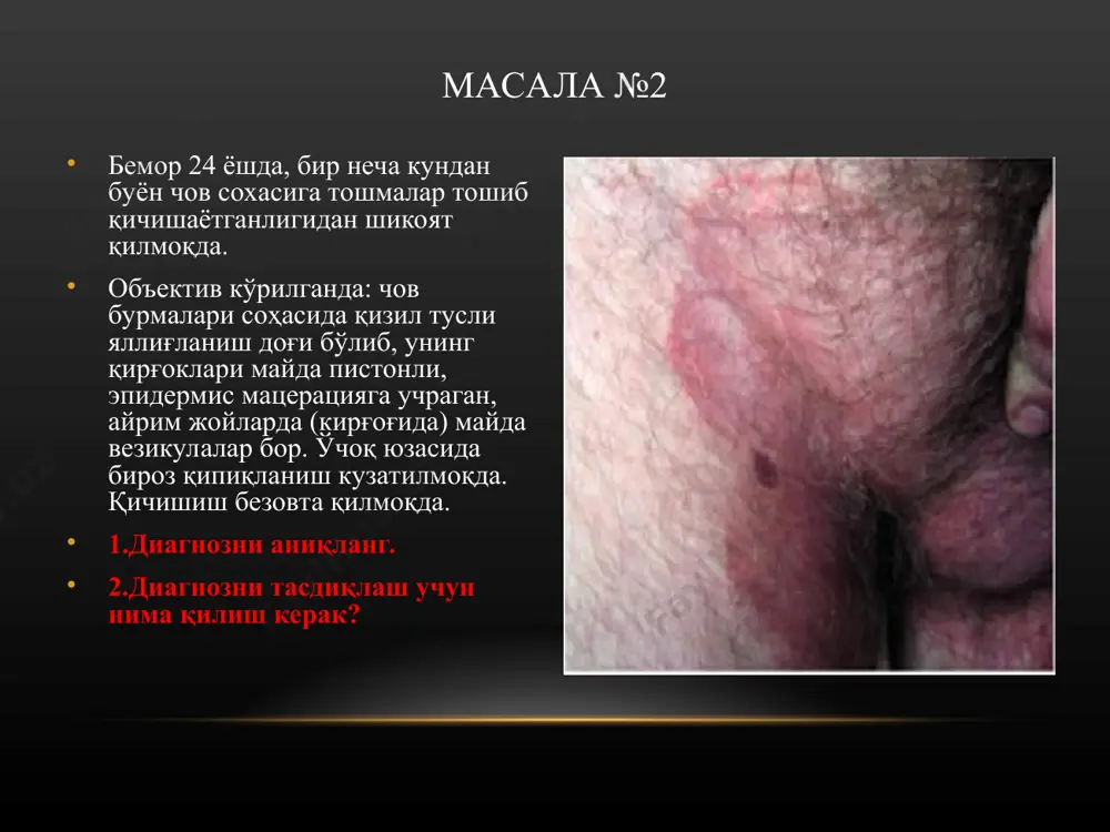 k? masala №8 dispanser shifokori qabuliga kelgan 10 yoshli bolada boshning sochli qismida kasallik o'chog'i mavjud bo'lib, ob'ektiv ko'rilganda: uning shakli dumaloq, o'lchami 4x5 sm, atrofida, jarohat sohasida kuchli infiltratsiya rivojlangan va yuzasida ko'pgina follikulyar yiringchalar bo'lib, ularning har biridan alohida-alohida yiring oqib chiqishi kuzatilmoqda, qaloqlar bor. kasallik o'chog'ida sochlar zararlangan. sizning diagnozingiz? diagnozni aniqlash uchun qanday tekshiruv o'tkaziladi? masala №9 kabulga kelgan 16 yoshli qizning chap tirsagida, bilak soxasida 1 ta kasallik o'chog'i bo'lib, ob'ektiv ko'rilganda: ular dumaloq shaklda. diametri 3x4 sm atrofida. u erda eritema dog'i, mayda yuzaki pustulalar, kepaklanish, qaloklar ko'zga tashlanadi. kasallik o'chog'i kirg'og'ida papulalardan iborat infiltratsiya teri soxasidan biroz ko'tarilib bordyur xosil qilib turibdi. o'chog'ning kirg'oqlari tekkis, chegarasi aniq. qanday kasallik? diagnozni tasdiklash uchun qanday tekshirish o'tkazish kerak? masala №10 14 yoshli bemorning peshona sohasida kaftdek kasallik o'chog'i bo'lib, ob'ektiv ko'rilganda: u erda teri qattiqlashib zichlashgan, ostidagi to'qimaga yopishgan, atrofida siren rangidagi hoshiya kuzatiladi. kasalik …