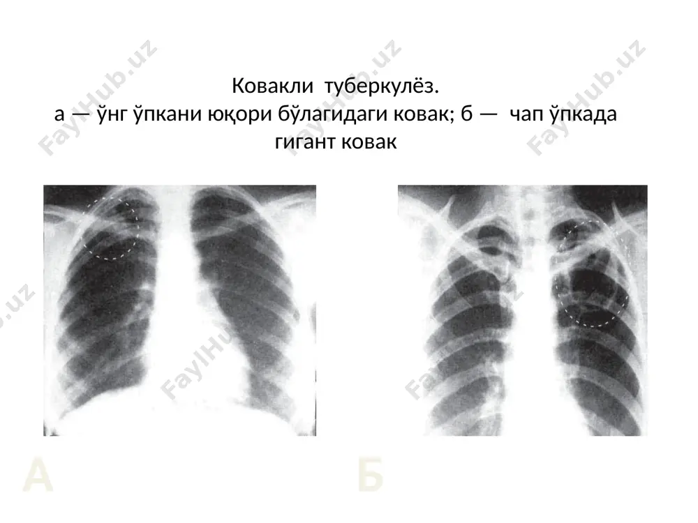 ўнг ўпкани ковакли туберкулези - Page 3