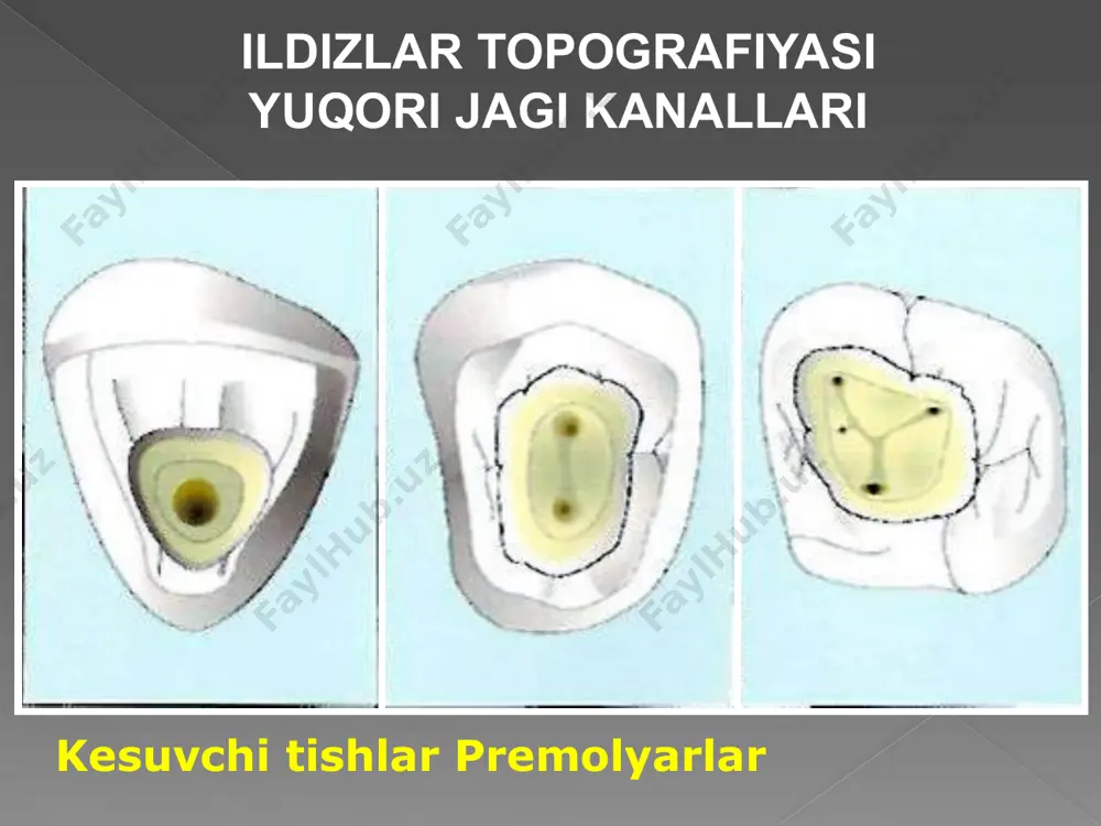 apical file yoki maf deb ataladi). 3. keyinchalik, kanal mafdan 1 mm qisqaroq ish uzunligi bilan №30 asbob bilan kengaytiriladi. ushbu fayl bilan ishlash tugagandan so'ng, dentin bo'laklari chiqariladi va kanal devorlari 25-sonli asbob bilan tekislanadi. 4. 30-fayldan keyin №35-fayl ish uzunligi maf uzunligidan 2mm kamroq, keyin №40-fayl 3mm kamroq va hokazo. har bir asbob ishlatilgandan so'ng, dentin chiplari maf butun ish uzunligi uchun chiqariladi. 5. kanalning og'zi bilan davolanadigeyts gliddenyokilargo. "step back" texnikasining kamchiliklari infektsiyalangan dentin chiplarini apikal teshik orqasiga surish yoki dentin "tiqin" hosil bo'lishi ehtimoli; kavisli kanallarni qayta ishlash va to'g'rilash paytida tishning ish uzunligining nazoratsiz o'zgarishi tufayli apikal torayish holatining buzilishi; ildiz devorining teshilish ehtimoli. click to edit master text styles second level third level fourth level fifth level tish ildizining cho'qqisi iz kanalni mexanik davola olish natijasi apikal siqilishlarning tasnifi apikal stop yaratish sxema: apikal to'xtash - bu gutta-percha ustunining uchi uchun to'xtashni ta'minlovchi kanal …