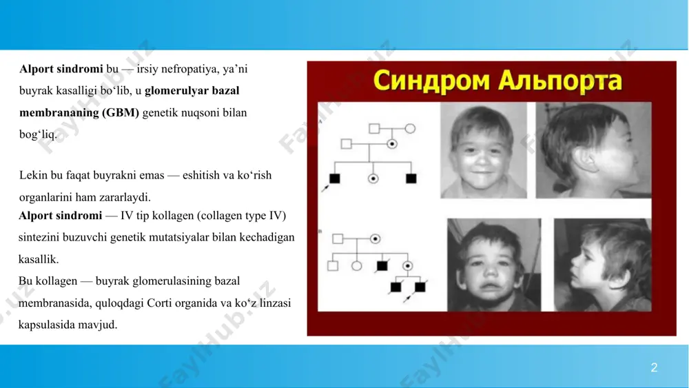 gbm)» dagi segmental qalinlash, yupqalash va «basket-weave» tuzilmalari 6 morfofunksional oqibatlar shikastlangan gbm: filtratsion barerni ushlab tura olmaydi, eritrotsitlar siydikka o‘tadi → gematuriya, keyin proteinuriya, podotsitlar (filtr hujayralari) distrofiyaga uchraydi → glomeruloskleroz, nihoyat, xronik buyrak yetishmovchiligi. tip iv kollagen nafaqat buyrakda — balki: corti organining bazal membranasida (eshitish apparati), ko‘z linzasi kapsulasida ham mavjud. shuning uchun: α5 zanjir yetishmasa → bazal membrana zaiflashadi → corti hujayralar nobud bo‘ladi → sensorinevral karsoqlik, linza kapsulasi noaniq shakllanadi → anterior lentikonus. 7 alport sindromining klinik belgilari buyrak belgilar (asosiy va erta) alport sindromining birinchi va eng barqaror belgisi — gematuriya. bosqichma-bosqich: bolalik davrida: mikrogematuriya (ko‘pincha tasodifan aniqlanadi); ba’zida o‘tkir respirator infeksiyadan keyin siydikda qon paydo bo‘ladi — bu “episodik gematuriya”. o‘smirlikka o‘tishda: proteinuriya qo‘shiladi (ko‘pincha subnefrotik darajada); arterial gipertoniya paydo bo‘ladi; sekin-asta glomeruloskleroz rivojlanadi. yosh ulg‘ayganda (20–30 yosh): surunkali buyrak yetishmovchiligi (kby) rivojlanadi; kreatinin oshadi, gfr pasayadi; terminal bosqich — dializ yoki transplantatsiya …