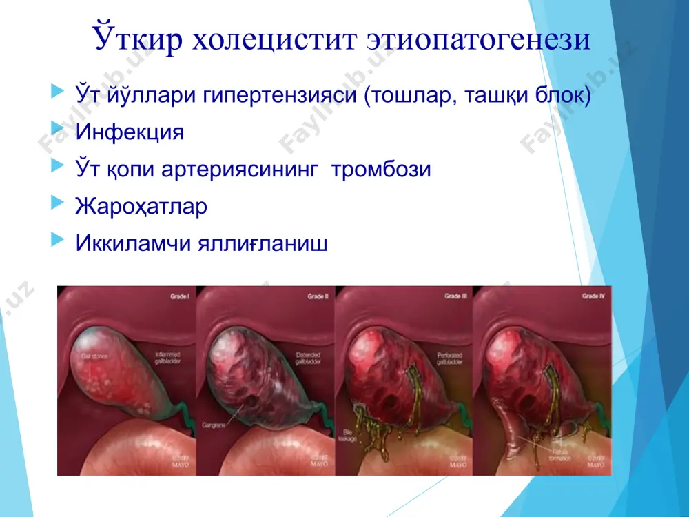 ўткир тошли холецистит - Page 5