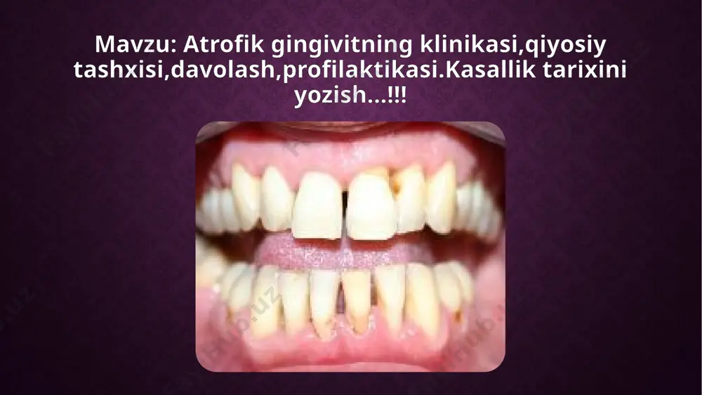 fik gingivit patologik jarayonda alohida tishlarni o'z ichiga oladi, ko'p hollarda bu kaninlar, premolyarlar va kesmalar. ta'sirlangan tish go'shti tishlarning ildizlaridan yuqoriga ko'tarilib, bo'yinlarini ochadi va sezuvchanlikni sezilarli darajada oshiradi. umumiy gingivit yumshoq gingival to'qimalarning massasining asta-sekin kamayishi bilan birga keladi, tishlar orasidagi papillalar amalda yo'qoladi va molarlar orasidagi bo'shliq sezilarli darajada oshadi. agar siz o'z vaqtida tish shifokoriga bormasangiz va kasallikni davolashni boshlamasangiz, periodontal kasallik bemorning gandiraklay boshlaganida va hatto sog'lom ko'rinadigan tishlari gandiraklab, tushib keta boshlaganda, ko'pincha rivojlangan shaklda asoratga aylanishi mumkin. alomatlar atrofik gingivitning belgilarini tish go'shtining qon ketishi bilan aniqlashingiz mumkin. shilliq qavatning soyasi o'zgara boshlaydi, tish go'shti oqarib ketadi, zichroq bo'ladi va to'qimalarning o'zi tishlardan yuqoriga ko'tarilib, bachadon bo'shlig'ini ochib beradi. molarning ildizi tashqi ta'sirlardan butunlay himoyasiz bo'lib qolganligi sababli, bemorning nerv uchlari sezgir bo'ladi. kasallik o'sib borishi bilan, interdental bo'shliq tobora ko'payib boradi, bu bakteriyalarning ko'payishi uchun qulay muhit yaratadi - ular oziq-ovqat qoldiqlari …