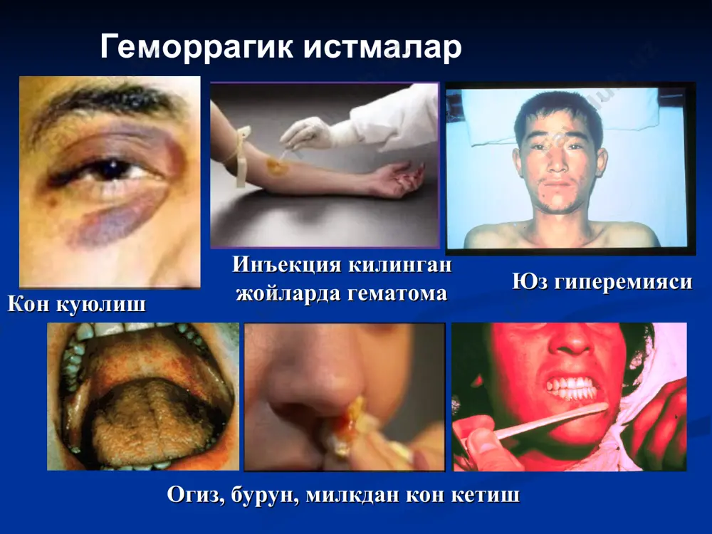 геморрагик истмалар - Page 4