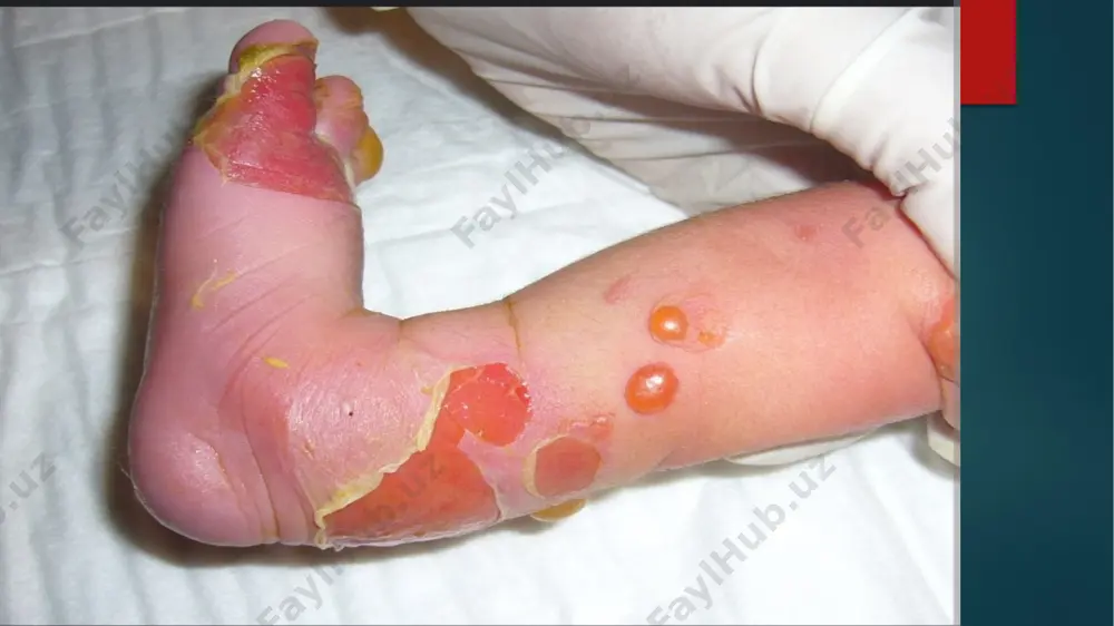 bullyoz dermatozlar differensial diagnostikasi.dyuringni dermatozi. pemfigus. - Page 5