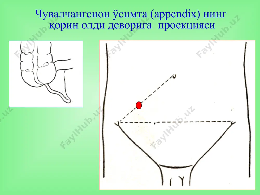 ади. огрик юкори жойлашади, мушаклар таранглиги ривожланмаган, михельсон, брендо симптомлари мусбат. карияларда – клиник манзара ривожланмаган, мушаклар таранглиги йук, лейкоцитоз йук, тана харорати нормал ўткир аппендицит дифференциал ташхислаш корин бушлик аъзолари касалликлари кукрак кафас аъзолари касалликлари корин орти сохаси аъзолари касалликлари инфекцион касалликлар кон ва кон-томир касалликлари гинекологик касалликлар тери касалликлари неврологик касалликлар қорин бўшлиғини ультратовушли текшируви қорин бўшлиғидаги эркин суюқлик лапароскопия махсус диагностика усуллари * диагностик лапароскопия тўғридан – тўғри қорин бўшлиғидаги патологик жараённи, шу жумладан ўткир аппендицитни, аниқлашга ёрдам берадиган усул ялиғланган ва ўзгармаган чувалчангсимон ўсимтани лапароскопик белгилари (кригер а.г. бўйича, 2000) чувалчангсимон ўсимта инструментда эркин осилиб туради чувалчангсимон ўсимта шишган ва у инструментда эркин осилиб турмайди, сирғалиб тушиб кетади дьяконов-волкович бўйича кесма кесмани босқичлари апоневрозни кесиш мускулларни очиш қорин пардани кесиш операция босқичлари кўр ичак губазини чиқазиш чувалчангсимон ўсимтани жароҳатга чиқазиш чувалчангсимон ўсимта тутқичини боғлаш операция босқичлари кисет чокини қўйиш аппендэктомия ўсимта чўлтоғини чўктириш ретроград аппендэктомия босқичлари …