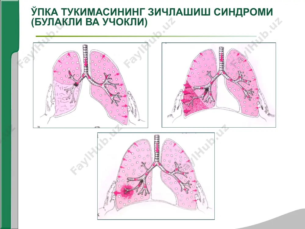 ализи: лейкоцитлар сони 15*109 - 25*109гача ошади ва 80-90% лейкоциларни нейтрофиллар ташкил килади, купинча лейкоцитар формула чапга силжиган. эозинофиллар сони камаяди ва огир холларда бутунлай йуколиши мумкин. лимфопения и моноцитоз кузатилади, эчт ошади. балгам анализи: куйилиш даври- ёпишкок, кизгиш тусли, куп оксил тутади, озрок лейкоцитлар, эритроцитлар, альвеоляр хужайралар, макрофаглар. кизил жигарланиш даври-балгам озрок, зангсимон рангда, фибрин, шаклли элементлар тутади. кунгир жигарланиш даври- балгамда лейкоцитлар сони ошади, у шиллик йирингли булади. тузалиш даври –лейкоцитлар детрит массага айланади, куплаб макрофаглар пайдо булади. микроблардан пневмококклар, стафилококклар, стрептококклар, фридлендер диплобациллалари топилади. рентгенологик: упканинг узгариши касалликнинг боскичига боглик. бошида упка накшининг кучайиши, сунгра бир-бирига кушилиб кетувчи сояланиш учоклари пайдо булади. хосил булган соя купинча упка булагига тугри келади. упка тиниклигининг нормал холатга келиши аста–секин содир булади ва 2-3 хафта давом этади. рентгенологик узгаришлар динамикаси даволаш жараёнини бошланиш даврига боглик. плевра бушлигига хаво ва суюклик тупланиш синдроми симптомлар мажмуаси, плевра варакларининг шикастланиши, плевра бушлигига суюклик ёки …