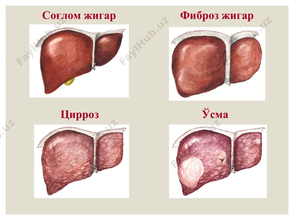 ш, жигарни пайпаслаш, шошилинч биопсия қилиш, портография ва портомонометрия ўтказиш. жигардаги қон томирларнинг эхографияда камлиги қопка вена диаметри талоқ ўлчамларининг катталашгани эзофагогастрофиброскопияда қизилўнгач ва меъданинг кардиал қисмида веналар варикоз кенгайиши борлиги, эзофагит белгилари аниқланиши, спленомонометрияда портал босимининг 1,86 дан 3,72 кпа қадар баланд бўлиши, спленопортографияда «буталган дарахт» ҳамда портал венанинг букилиб қолганлигини аниқлаш катта аҳамият касб этади. эгдфс: кизилунгач веналарининг варикоз кенгайиши давоси. сурункали гепатит ва жигар циррозининг фармакотерапияси етарлича яхши ишлаб чиқилган бўлиб, тегишли қўлланмаларда батафсил ёритилган. бундай беморларни жаррохлик йўли билан даволаш эса ҳанузгача мураккаб ва долзарб ҳисобланади. м. д. пациора (1984) портал гипертензияда қўлланадиган барча жаррохлик муолажаларини 5 гуруҳга бўлади: портал гипертензияда қўлланадиган жаррохлик муолажалар 1. асцит суюқлигини қорин бўшлиғидан чиқаришга қаратилган операциялар (сон тери ости венаси билан анастомоз, перитонеовеноз шунт ва б.) 2. портал системадан суюқлик оқиб кетадиган янги йўл яратишга қаратилган операциялар (оментопексия — оменто — гепатодиафрагмапексия — тальм операцияси, портокавал анастомозлар). портал гипертензияда қўлланадиган …