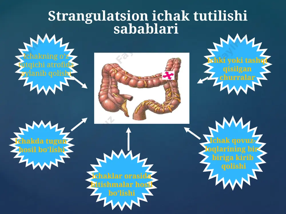 shiga olib keladi. bu kasallikni yo’g’on ichak oxirgi qismi yetishmovchiligi-tug’ma aganglioz deb atash mumkin. ya’ni girshprung kasalligida avtonom nerv tugunlari yo’g’on ichak devorida yetishmovchiligi yoki bo’lmasligi sababli najas ichakning tor qismida to’planib, ichakning yuqori qismi kengayishi va ichak devorining kompensator qalinlashishi belgilarinamoyon bo’ladi va ichak tutilishiga olib keladi. etiologiya va patogenez: tasnifi: rektal turi to’g’ri ichak oraliq qismining agangliozi to’g’ri ichakning ampula va ampula usti sohasi agangliozi sigma ichak pastki qismining agangliozi ishlamasligi sigma ichakning hamma yoki ko’p qismining ishlamasligi total turi subtotal turi segmentar turi rektosigmoid turi bitta segment to’gri va sigmasimon ichak oralig’ida yoki sigma ichakdagi aganglioz ikkita segment va ular orasida normal ichak bo’lishi yo’g’on ichak chap tomonining butunlay agangliozi yo’g’on ichak chap va qisan o’ng tomonini agangliozi yo’g’on ichakning butunlay agangliozi klinika erta paydo bo’ladigan belgisi: ich qotish, qorin dam bo’lishi,qorinning kattalashishi kech paydo bo’ladigan belgisi qusish, qorin og’rig’i,paradoksal ich ketish. asoratli belgisi: kamqonlik o’soshdan orqada …