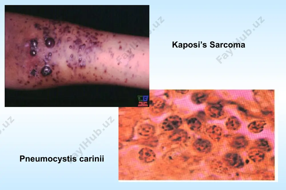 may be due to esophageal candidiasis. a characteristic intestinal pathogen in aids is cryptosporidium. salmonellae, mycobacteria, cmv or adenoviruses also frequently cause intestinal infections. systemic strongyloidosis may occur. chronic colitis is common in male homosexuals («gay bowel syndrome»), from which ameba, lamblia and a host of diarrheagenic bacteria have been reported. candidiasis c. central nervous system: the typical cns opportunistic infections are toxoplasmosis and cryptococcosis. infections are also seen with cmv, herpes simplex, papovaviruses, mycobacteria, aspergillus and candida. lymphomas of the central nervous system are common. d. malignancies: kaposi's sarcoma is the characteristic lesion seen in male homosexuals. it is an indolent multifocal nonmetastasising is mucosal or cutaneous tumor, probably of endothelial origin. the other tumors commonly seen are lymphomas, both the hodgkin and non hodgkin types. e. cutaneous. besides kaposi's sarcoma, herpes lesions, candidiasis, xeroderma, seborrheic dermatitis, prurigo, folliculitis, impetigo and molluscum contagiosumn are common cutaneous lesions. f. dementia. …