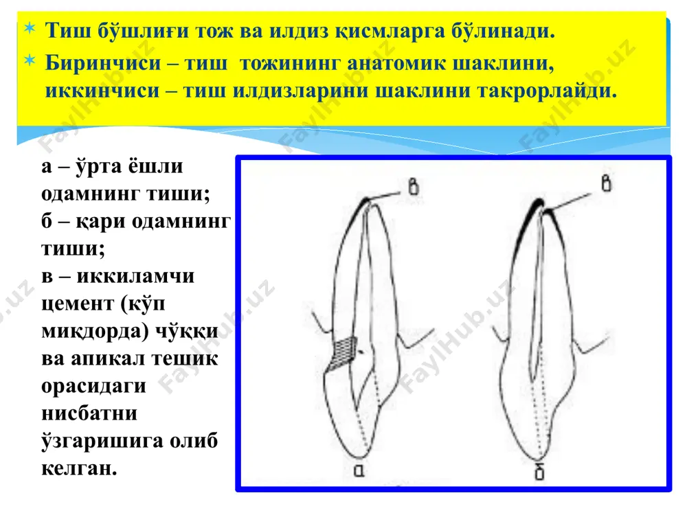 ) 46 дистал канал медиал тил канали медиал лунж канали 4-канал пастки 1 моляр ўртача узунлиги 22 мм (20-24 мм). одатда иккита илдизи (97,8%), 3та канали бор. 2,2% учта илдиз учраши мумкин. дистал канали овал шаклда, яхши ўтувчи, медиал. илдизда иккита канал – медиал-лунж ва медиал-тил, 40-45% иккала канал битта чўққи тешиги билан тугалланади . каналларга кириш тешиклари учбурчакни эслатади. тиш бўшлиғи чайнов юзадан дистал канал томонга очилади. пастки 2 моляр ўртача узунлиги 21мм (19-23 мм). одатда 2 илдизи, 3 канали бор. мезиал каналлари 49% чўққида кўшилиб кетади. дистал илдизда битта канал бўлиб, 28% - 2та бўлиши ҳам мумкин. дистал илдиз 74% тўғри йуналган, мезиал илдиз эса 84% дистал томонга қийшайган, 8% медиал ва дистал илдизлар қўшилиши мумкин. тиш бўшлиғи ўртада жойлашган бўлиб, тўртбурчакни эслатади. тиш бўшлиғи чайнов юзадан очилади пастки 3 моляр ўртача узунлиги 19мм (16-20 мм). коронка шакли ва илдизлар сони турлича бўлиши мумкин. тиш бўшлиғи чайнов юзадан …