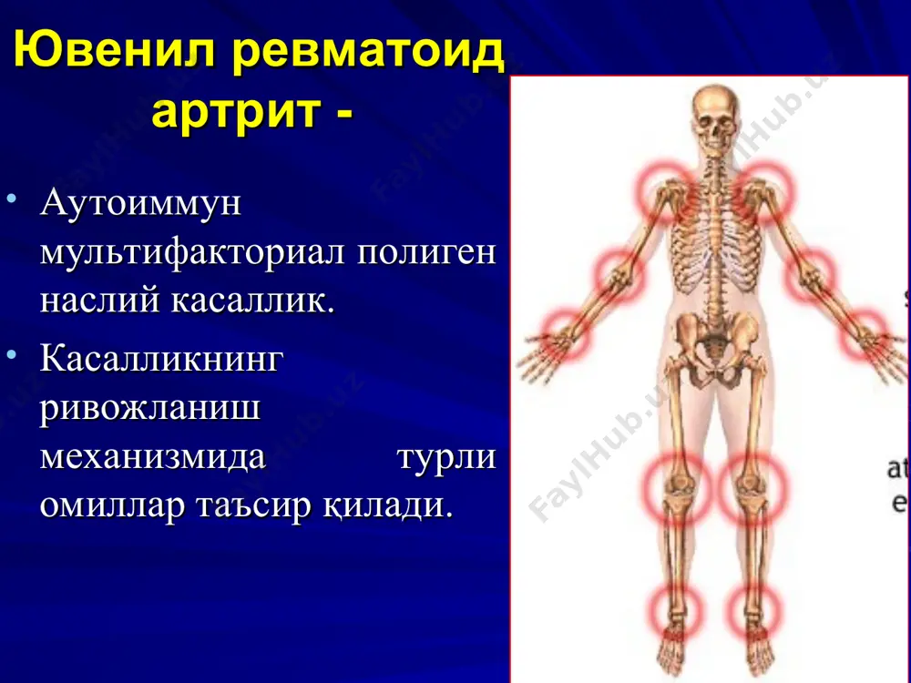 стилл синдроми висслер-фанкони синдроми бўғим-висцерал шакли асосий клиник симптомлар стилл синдроми висслер-фанкони синдроми ўткир бошланиши + + ўртача иситма + - юқори давомли иситма - + майда бўғимлар зарарланувчи полиартрит + - йирик бўғимлар зарарланувчи полиартрит - + давомли артралгия - + лимфоаденопатия + + гепатоспленомегалия + + полисерозит + + миокардит + + камқонлик + - нейтрофил гиперлейкоцитоз - + эчт яққол ортиши + + ревматоид артрит ташхиси юранинг ўзига хос хусусиятлари қуйидагилар: касалликни 16 ёшгача ривожланиши; артрит клиникаси (бўғимлар шиши, суюкликни борлиғи, бўғим соҳасида ҳарорат кўтарилиб, ҳаракат ҳажмининг чегараланганлиги ва оғриқ); касаллик 6 ой ва ундан кўп давом этиши; юранинг асосий шакллари (бўғим-висцерал, олигоартикуляр, полиартикуляр) қуйидагилар билан ташҳисланади: а) иситма бор ёки йўқлиги; б) касалликнинг биринчи 6 ойида шикастланган бўғимлар сони . лимфоаденопатия увеличение лимфоузлов всех групп наиболее выражена при системных формах заболеваний (увеличение до 4 – 6 см в диаметре) и при полиартикулярном варианте лимфоузлы подвижные, безболезненные, …
