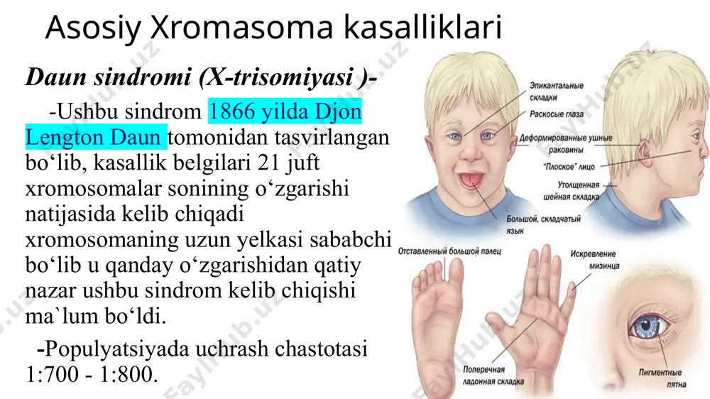 daktiliya,klinodaktiliyasi, maymoqlik, kriptorxizm. bolaning yoshi kattalashishi bilan ―mushuk chinqirig‘i‖ simptomi mushak gipotoniyasi, oysimon yuz belgilari tobora yo‘qolib boradi, mikrosefaliya, psixomotor yetishmovchiliklar, g‘ilaylik kuchliroq namoyon bo‘ladi. quloq deformatsiyalari va nisbatan past joylashishi, sindaktiliya, klinodaktiliyasi, maymoqlik, kriptorxizm. bolaning yoshi kattalashishi bilan ―mushuk chinqirig‘i simptomi mushak gipotoniyasi, oysimon yuz belgilari tobora yo‘qolib boradi, mikrosefaliya, psixomotor yetishmovchiliklar, g‘ilaylik kuchliroq namoyon bo‘ladi. image1.png image2.png image3.png image4.png image5.png image6.png image7.jpeg image8.jpeg image9.jpeg image10.jpeg image11.jpeg image12.png image13.png image14.jpeg image15.jpeg image16.jpeg image17.jpeg image18.jpeg /docprops/thumbnail.jpeg