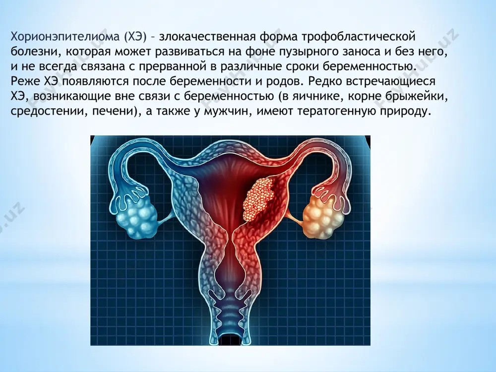 elioma nemetastaticheskaya (ogranichena matkoy) metastaticheskaya (prorastaet v sosednie tkani) s blagopriyatnim prognozom s neblagopriyatnim prognozom po sovremennoy klassifikatsii vsemirnoy organizatsii zdravooxraneniya videlyayut chetire stadii razvitiya xorionepiteliomi: i. opuxol naxoditsya v matke; ii. opuxol rasprostranilas za predeli matki, no naxoditsya v predelax polovix organov; iii. rasprostranenie metastazov v legkie; iv. metastazi rasprostranyayutsya i na drugie organi, pomimo legkix. raznoobraznaya i rannyaya klinika metastazov dala osnovanie nazvat xorionepiteliomu boleznyu metastazov. dlya xorionepiteliomi xarakterno otsutstvie stromi i svoix sosudov. rakovie kletki nachinayut prorastat v krovenosnie sosudi, vsledstvie chego proisxodit lizis endoteliya. na stenke sosuda razvivaetsya nekroz, chto yavlyaetsya patogeneticheskim mexanizmom, provotsiruyushim krovotechenie i tromboz. xorionepitelioma chashe bivaet u jenshin s povtornimi beremennostyami v anamneze. latentniy period sostavlyaet vremya ot poslednix rodov do obrazovaniya opuxoli, mojet dlitsya ot mesyatsa do 15-20 let. kak pravilo zabolevayut jenshini ot 18 do 55 let. rasprostranyaetsya novoobrazovanie vdol krovenosnix sosudov intravazalno i ekstravazalno. pri intravazalnom roste zlokachestvennoe novoobrazovanie …