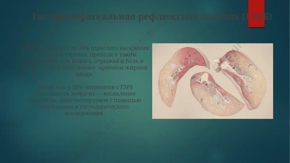 zabolevaniya organov pishevaritelnoy sistemi - Page 5