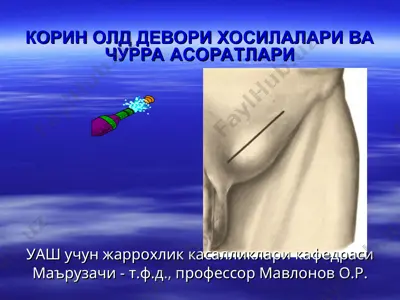 корин олд девори хосилалари ва чурра асоратлари — PPT