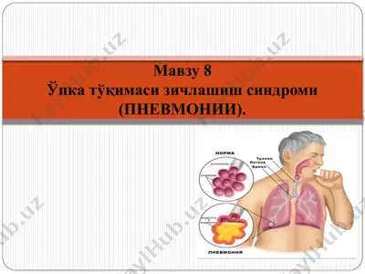 ўпка тўқимаси зичлашиш синдроми(пневмонии) — PPTX
