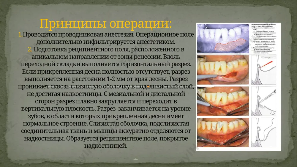 й мукотом (aesculap) позволяет получать лоскуты фиксированной ширины и толщины. -ширина 6,5 мм -толщина 0,75 мм с помощью ручного или машинного мукотома забирают фрагмент ткани прямоугольной формы, который затем корректируют по форме реципиентного поля. забор ткани с поверхности неба выполняется под местной анестезией. если раствор анестетика вводится под давлением, слизистая оболочка неба слегка приподнимается и ее легче отделить от твердых тканей после выполнения разрезов. разрезы не должны быть слишком глубокими, иначе можно повредить небную артерию. -получение небного лоскута с помощью ручного мукотома pr 1(7 мм) режущую головку слегка сдвигают вперед-назад. чтобы разрез был точным, можно направлять инструмент указательным пальцем левой руки. идеальный лоскут имеет равномерную толщину не более 1 мм. при получении трансплантата с помощью машинного мукотома нужно учитывать, что нижняя соединительнотканная поверхность такого лоскута столь гладкая, что ее можно спутать с эпителиальной. поэтому перед операцией следует пометить эпителий нетоксичным водостойким маркером. если пересадить лоскут неправильной стороной, он не приживется!!!! …