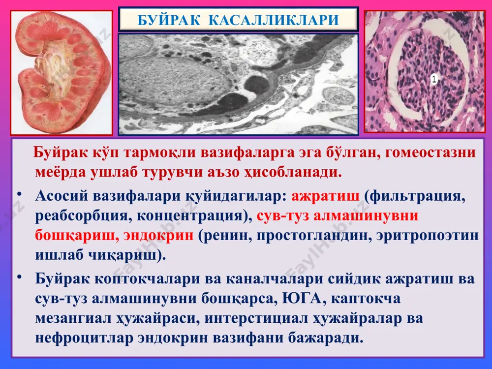 йсимон инфильтрат 2. каптокча, томирлари тўлақонли 3. каналчада оқсил модда тез авж олувчи гломерулонефрит 1 2 3 сурункали гломерул-рит. 12 ойдан узоқ, яширин ва рецидивланиб кечиш хос. сабаби номалум, механизми – иммун бирикма реакция. морфология 2 типи фарқ қилинади: мезангиал ва склерозланган. мезангиал гломерулонефрит: икки турда учрайди: 1) мембрано-пролифератив (мезангиокапилляр), 2) мезангиопролифератив. морфологик жиҳатдан буйрак каптокчалари йирик, мезангиоцит-лар пролиферацияланиб кўп ҳужайрали, гбм қалинлашган, унда иммун депозитларнинг интерпозицияси, иккига ажралиши, “темир йўлсимон” базал мембрана. каптокчаларда бўлакчалар пайдо бўлиб, лобуляр гломерулонефрит юзага чиқади. каптокчалар ўзгаришлардан ташқари, каналчалар эпителийсида дистрофия ва атрофия, стромада интерстициал лимфогистиоцитар инфильтрация ва склероз ривожланади. оқибатда буйрак иккиламчи бужмайишга учрайди. диффуз склерозланган гломерулонефрит. бу гломерулонефритнинг барча турлари якунловчи даври ҳисобланади. ёруғлик микроскоп остида буйрак тўқимасида склероз, гиалиноз, каптокчалар ва каналлар атрофияси аниқланади. макро – буйраклар кескин кичиклашган, каттиқлашган, юзаси майда донадор тусга кирган ва “иккиламчи бужмайган буйрак” дейилади. сурункали гломерулонефрит электрон микроскопияда базал мембранада (1) осмиофил депозитлар мезангиопролифератив гломерулонефрит …