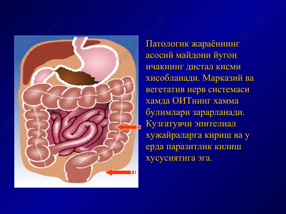 гглютинацияловчи хусусияти билан катнашади. касалликнинг биринчи кунларида, ичакда кучли структур –функционал узгаришлар даврида ахлатда хам секретор, хам зардоб jga топилади, бу ичак бушлигида зардоб оксилларининг транссудацияси кучайиши натижасида юзага келади. антителолар ишлаб чикарилади, иммуноглобулинлар активланади. реконвалесценция даври бошланади. паталогик анатомияси а. катарал- фолликуляр колит б. фибриноз-ярали колит а. соглом йугон ичак шиллик кавати. б. катарал-фолликуляр колит. в. эррозив-ярали колит. г. атрофик колит. а. б. в. г. дизентериянинг клиник таснифи уткир дизентерия 1. колитик шакли: - енгил; - урта огир; - огир; - ута огир; - яширин дизентериянинг клиник таснифи 2. гастроэнтероколитик шакли: - енгил; - урта огир; - огир; - ута огир; - яширин. дизентериянинг клиник таснифи ii. бактерия ташувчилик ш.сурункали дизентерия 1. кайталовчи 2. узлуксиз уткир дизентерия енгил колитик шакли- уткир бошланади, t= 37 – 38с, холсизлик, иштаха пасайиши кузатилади. коринда кучсиз огрик, ич келиши 3-5 марта, лекин 10 мартадан куп эмас. уткир дизентериянинг енгил шакли клиник кечиш характеристикаси …