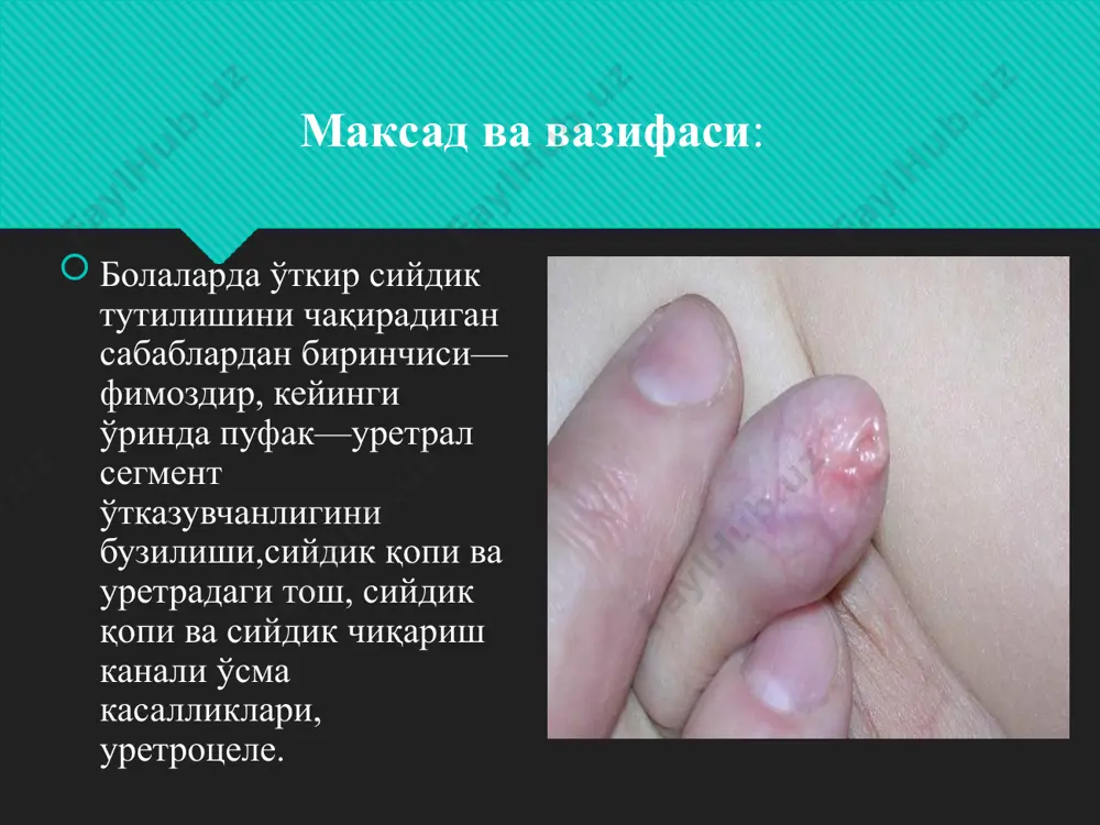 ва фосфатлар коннинг биохимик анализи ташхис куйишдаги инструментал текширув: утт, корин бушлиги рентгенографияси, экскретор ва инкретор урография врач педиатр даволаш-услуби анурияни ва ўткир сийдик тутилишини даволаш услуби сабабларига боғлиқ ҳолда консерватив ва оператив бўлади. анурия ва ўткир сийдик тутилишида госпиталгача бўлган босқичда кўрсатиладиган ёрдам: спазмолитиклар (но-шпа, баралгин, папаверин). иссиқ ванна, бел сохасига иссиқлик. новокаинли блокада уруғ тизимчасига ва бачадон юмалоқ бойламига лорин- эпштейну буйича. уретранинг орқа қисмига тош тиқилиши сабабли келиб чиққан ўткир сийдик тутилишида – ташқи сийдик каналига иссиқ глицерин эритмасини босим билан жўнатиш ва катетер ёрдамида тошни қайта сийдик пуфагига итариш. анурия ва ўткир сийдик тутилишида сабабидан қатъий назар стационар шароитда даволанади. стационардан чиққандан сўнг турли дори препаратлардан чегараланади ва профилактик эмлашлар қолдирилади. обструктив уропатия ва ўткир сийдик тутилиши реабилитацияси ва диспансеризацияси эътиборингиз учун рахмат