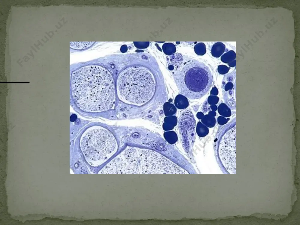 ipp, qizamiq, gemofil tayoqchalar, parotit, mikoplazma). – gerpetik infeksiyalar (smv, epstayn–barr, varicella-zoster). – oits va laym-borrelioz kasalligi. – turli virusli kasalliklarga (gripp, qoqshol, quturish) qarshi emlashlar. – xirurgik operatsiyalar. – turli dorilar (masalan, trombolitik dorilar) ning nojo‘ya ta’siri yoki asoratlari. – pns ga toksik ta’sir ko‘rsatuvchi kimyoviy vositalar, nur- lanishlar. – turli autoimmun kasalliklar (sistem qizil bo‘richa). – onkologik kasalliklar (limfogranulematoz, limfomalar). – etiologiyasi noaniq holatlar. tasnifi. giyen-barre sindromining 3 ta klinik turi farqlanadi. 1. o‘tkir yallig‘lanish bilan kechuvchi mielinsizlanuvchi poliradikulonevropatiya. bu gbs ning klassik turi bo‘lib, u 80– 90 % holatlarda uchraydi. 2. gbs ning aksonal turi (aksonal nevropatiya). kam uchraydigan turi, ya’ni 10–20 % ni tashkil qiladi. 3. miller-fisher sindromi. juda kam (1–3 %) uchraydi. difteriya polinevriti difteriyaning o‘tkir belgilaridan 2—3 haftadan keyin asab tizimida zararlanish belgilari namoyon bo‘ladi. difteriyadagi polinevritda periferik asab tolalarining zararlanishi chegaralangan mononevrit yoki tarqalgan polinevritlar kabi kechadi. polinevritning rivojlanishida difteriya kasalligidan yaxshi davolanmagan …