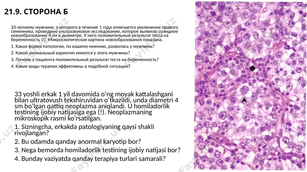 day? 4. neoplazmaning terapiyaga javobini qanday baholash mumkin? ответы: сторона а 1. эта пестрая опухоль (♦) — смешанная эмбрионально-клеточная опухоль. 2. повышение уровня афп указывает на компонент эмбрионального рака желточного мешка. повышение уровней хгч обусловлено их продукцией синцитиотрофобластами. если они смешаны с цитотрофобластами, то предполагается компонент хориокарциномы. пестрота окраски указывает на наличие тератомы с возможным вовлечением многих типов тканей. 3. метастазы за пределами забрюшинных лимфоузлов и выше диафрагмы указывают на стадию iii опухолевого роста. 4. количество лдг умеренно коррелирует с опухолевой нагрузкой. снижение уровней хгч и афп свидетельствует об ответе опухоли на терапию. 1. bu lekeli o'simta (♦) aralash embrion hujayrali o'simtadir. 2. ko'tarilgan afp darajasi homila sarig'i qop saratoni komponentini ko'rsatadi. hcg darajasining oshishi ularning sinsitiotrofoblastlar tomonidan ishlab chiqarilishi bilan bog'liq. agar ular sitotrofoblastlar bilan aralashtirilgan bo'lsa, u holda choriokarsinoma komponentiga shubha qilinadi. rangning xilma-xilligi ko'p turdagi to'qimalarning mumkin bo'lgan ishtiroki bilan teratoma mavjudligini ko'rsatadi. 3. retroperitoneal limfa tugunlari …