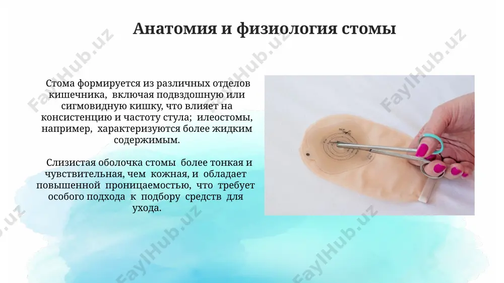 ey koji vokrug stomi; svoevremennaya profilaktika i lechenie kremami s tsinkom kriticheski vajni. krovotechenie iz stomi, previshayushee 5 ml/sutki ili soprovojdayusheesya tyomnim tsvetom krovi ili sgustkami, ukazivaet na potentsialnoe seryoznoe oslojnenie i trebuet nemedlennogo obrasheniya k vrachu. psixologicheskaya podderjka effektivnost kognitivno-povedencheskoy terapii (kpt) v lechenii trevogi i depressii u patsientov so stomoy sostavlyaet okolo 80%, po dannim mnogochislennix issledovaniy, i pomogaet v virabotke navikov samoregulyatsii. bolee 70% patsientov ispitivayut trevogu i depressiyu posle operatsii so stomoy, chto negativno vliyaet na adaptatsiyu k novomu obrazu jizni i soblyudenie rekomendatsiy po uxodu. psixologicheskaya podderjka neobxodima dlya snijeniya urovnya stressa. primenenie kalopriemnikov pravilniy podbor razmera kalopriemnika – klyuchevoy faktor uspexa. nepravilniy razmer (na 1-2 sm bolshe ili menshe) mojet vizivat protekaniya ili diskomfort, vliyaya na kachestvo jizni patsienta. dlya fiksatsii kalopriemnika ispolzuyutsya spetsialnie adgezivnie plastini. vajno sledit za ix tselostnostyu i svoevremenno zamenyat, izbegaya otkleivaniya, chto mojet vizvat vitekanie soderjimogo i razdrajenie. tipi …
