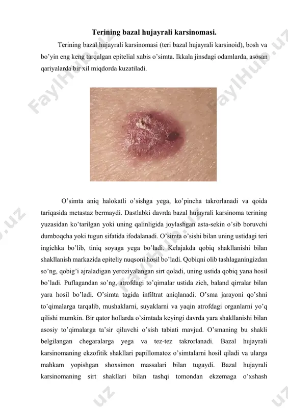avjudligi bazal hujayrali karsinoma ko’rinishini sezilarli darajada o’zgartiradi va uni melanomaga yuzaki o’xshash qiladi. bazal hujayrali karsinomaning xilma-xil klinik ko’rinishi tashxis qo’yishda muayyan qiyinchiliklarni keltirib chiqarishi mumkin, shuning uchun sitologik va gistologik tekshirish usullari hal qiluvchi ahamiyatga yega. bosh va bo’yin teri saratoni. yassi hujayrali teri saratonining dastlabki klinik ko’rinishlari yuqorida tavsiflangan bazal hujayrali karsinomaning dastlabki belgilariga mos keladi biroq, o’smaning o’sish tezligi bazal hujayrali karsinomaga qaraganda ancha yuqori. teri saratonining klinik ko’rinishini ko’rib chiqishda uchta asosiy shakl ajratiladi: yarali; yekzofitik yoki papiller va infiltrativ. klinik shakllarni ajratishda shuni yodda tutish kerakki, bu bo’linish shartli va o’tish sharoitlari mavjud bo’lib, uni yuqorida aytilganlarning hech biriga bog’lab bo’lmaydi. teri saratonining yarali-yallig’lanish shakli yeng keng tarqalgan. kasallik terining qalinligida joylashgan muhr shaklida namoyon bo’ladi, uning ustida tez orada eroziya paydo bo’ladi, qobiq bilan qoplangan. qobiqni olib tashlashda mayda tanali sirt ochiladi, u yengil shikastlanish bilan oson qon ketadi. kasallikning keyingi yo’nalishi bilan …