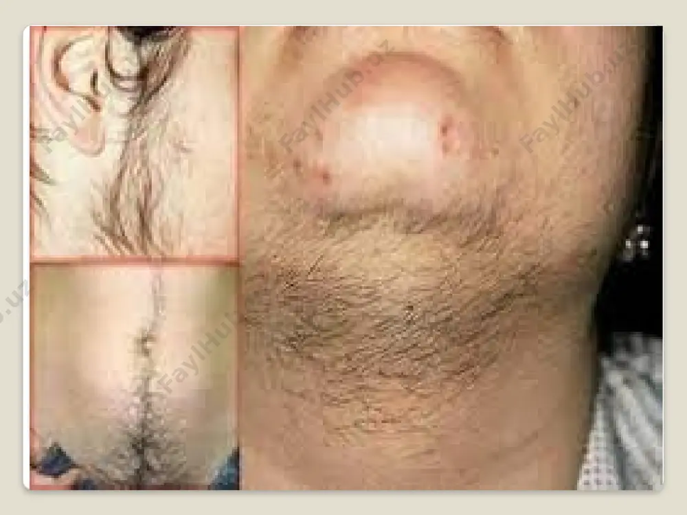 bezi tomonidan stimulyatsiyasi ovulyatsiyaga olib kelmaydi. androgenlarning ortiqcha ishlab chiqarilishi follikullar atreziyasiga, stroma va oqsil membranasining giperplaziyasiga olib keladi. bu shafqatsiz doirani yopadi va tsiklning uzilishlarini oshiradi. testosteronning ortiqcha bo'lishi erkak sindromi belgilarining namoyon bo'lishiga olib keladi. konjenital adrenal giperplaziya uchun jarrohlik davolash qo'llanilmaydi. tuxumdon o'smalari va buyrak usti o'smalarini maskulinizatsiya qilish uchun ko'rsatiladi. gipofiz adenomasini olib tashlash uchun neyroxirurgiya bo'limida kasalxonaga yotqizish kerak. jarrohlikdan keyin gamma nurlari yoki protonlar bilan radiatsiya terapiyasi kursi talab qilinishi mumkin. viril sindromini jarrohlik yo'li bilan tuzatish polikistik kasallik uchun samarali. laparoskopik kirish tuxumdonlarni xanjar rezektsiyasi yoki termal yoki lazer usullari yordamida kauterizatsiya qilish orqali amalga oshiriladi. tuxumdonlarning demodulyatsiyasi ham qo'llaniladi. aralashuvdan so'ng homiladorlik 6-12 oy ichida sodir bo'ladi, ammo keyinchalik kontseptsiya ehtimoli tezda pasayadi. klinik rasm virilizatsiyaning namoyon bo'lishi endokrin o'zgarishlar sodir bo'lgan yoshga bog'liq. kasallikning og'irligi qondagi androgenlarning ko'payishiga bog'liq. yangi tug'ilgan chaqaloqlarda virilizatsiya psevdohermafroditizmga olib kelishi mumkin. qiz bola erkaknikiga o'xshash …