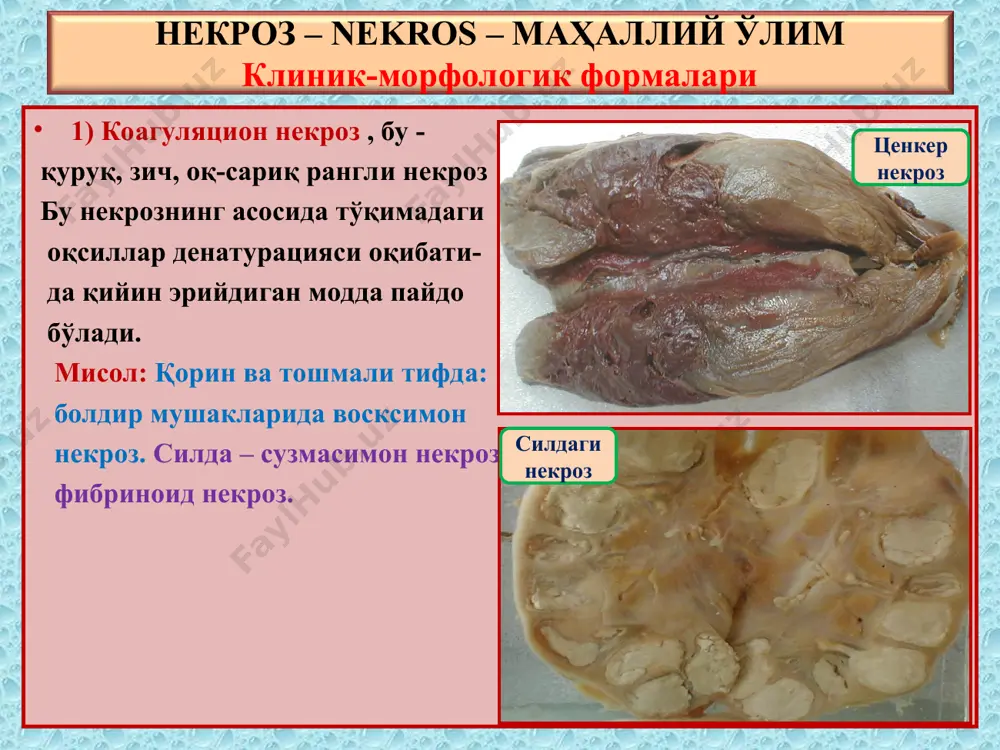 сти юмшоқ тўқима некрози. узоқ ётиб қолган касалларда, бўртиб чиққан суяклар соҳасида пайдо бўлади. 11) атероматоз некроз – атеросклероз касаллигида аорта деворида бўтқасимон некроз кўринишида пайдо бўлади. тери аорта некроз – клиник-морфологик формалари 12) апоптоз, бу – ҳужайралар ўз иш фаолиятини тугатгандан кейинги, дастурланган ўзини ўзи ўлдириш. хужайраларнинг мембрана билан ўралган бўлакчаларга бўлиниши ва макрофагларга фагоцитозланиши. некроз – клиник-морфологик формалари 1) коагуляцион некроз – склероз, охакланиш. 2) колликвацион некроз – тўқиманинг эриши. 3) гангрена – мумификация, ампутация, нома. 4) секвестр – инкапсуляция, йиринглаш, оқма бўлиш. 5) инфаркт – скрероз, чандиқ, кардиосклероз, киста. 6) фибриноид некроз – томир ёрилиши. 7) сузмасимон некроз – охакланиш, склероз. 8) ётоқ яра – чандиқ, йиринглаш. 9) атероматоз некроз – кальциноз, яраланиш. 10) елимсимон некроз – склероз, киста, охакланиш. 11) апоптоз – фагоцитоз. некроз – оқибатлари