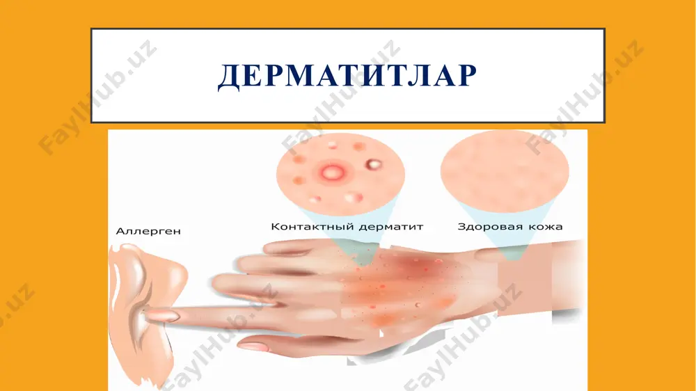 i tugunchali- pufakchali hamda pufakli toshmalar kŭrinishida namoën bŭladi. kŭpincha bundaĭ toshmalarning nafaqat teri sohalariga, balki shilliq qavatlarga ham tarqalishi kuzatiladi. aĭrim hollarda toksikodermiyalar qandaĭ dori vositalarining zaharli ta'siridan sŭng paĭdo bŭlganligini aniqlash mumkin: yod va brom dori vositalari ta'siridan sŭng teri sohalarida ularga xos bŭlgan husnbuzarsimon toshmalar tarzida, ŭsimtalar ëki tugunlar tarzida namoën bŭladi, sulfanilamid dori vositalaridan sŭng esa jaraën tŭqqizil, qŭng'irsimon chegaralangan ŭchoqlar tarzida namoën bŭladi. toksikodermiya kasalligining ŭziga xos bŭlgan klinik shakllaridan biri laĭellaning toksiko-allergik pufakli epidermal nekrolizi hisoblanadi. kasallik birdan teri va shilliq qavatlarda katta hajmdagi, tŭqqizil yallig'langan ŭchoqlarning paĭdo bŭlishi hamda ular asosida esa pufakli toshmalarning kuzatilishi bilan boshlanadi. pufakli toshmalarni ërilishi pŭsti tez kŭchadigan eroziyalarning hosil bŭlishiga olib keladi, ularning sathi hŭllanib turuvchan bŭlib, nikolskiĭ belgisi musbat kŭrinishda bŭladi. bemorlarning umumiĭ ahvoli og'ir bŭladi, ularda holsizlik, badan qaqshashi, darmonsizlik, ishtahaning pasaĭishi, tana haroratlaring septik 39°-40° darajagacha kŭtarilishi, yurak va buĭrak faoliyatlarining buzilishi kabilar kuzatiladi. …