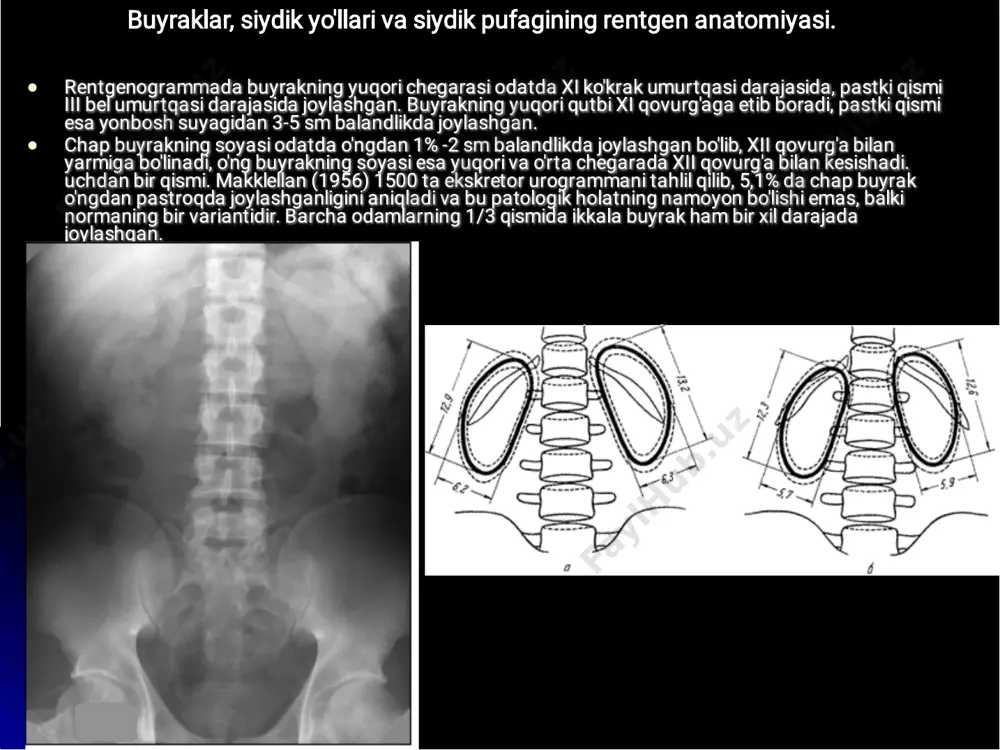 utblari ko'proq lateral joylashgan va shuning uchun burchak ayollarga qaraganda kattaroqdir. buyrakning uzunlamasına o'qi burchagini aniqlash ba'zan kichik diagnostik ahamiyatga ega emas. shunday qilib, turli xil buyrak anomaliyalari, buyraklardagi patologik jarayonlar (pyelonefrit, o'smalar, nefroptoz va boshqalar) bilan buyrakning uzunlamasına o'qining yo'nalishi o'zgaradi; xususan, pielonefrit bilan buyrakning uzunlamasına o'qi tananing o'rta chizig'iga parallel bo'ladi. buyrakning uzunlamasına o'qi m soyasiga taxminan parallel ravishda joylashgan. psoas. buyrak soyalarining pastki qutblari orasidagi gorizontal masofa odatda 11 sm ni tashkil qiladi, yuqoridagilar orasida esa 7 sm. erkaklarda buyraklarning pastki qutblari ko'proq lateral joylashgan va shuning uchun burchak ayollarga qaraganda kattaroqdir. buyrakning uzunlamasına o'qi burchagini aniqlash ba'zan kichik diagnostik ahamiyatga ega emas. shunday qilib, turli xil buyrak anomaliyalari, buyraklardagi patologik jarayonlar (pyelonefrit, o'smalar, nefroptoz va boshqalar) bilan buyrakning uzunlamasına o'qining yo'nalishi o'zgaradi; xususan, pielonefrit bilan buyrakning uzunlamasına o'qi tananing o'rta chizig'iga parallel bo'ladi. rentgenogrammalarda oddiy buyraklarning soyalari quyidagi o'rtacha o'lchamlarga ega: uzunligi 11,5 sm va kengligi …