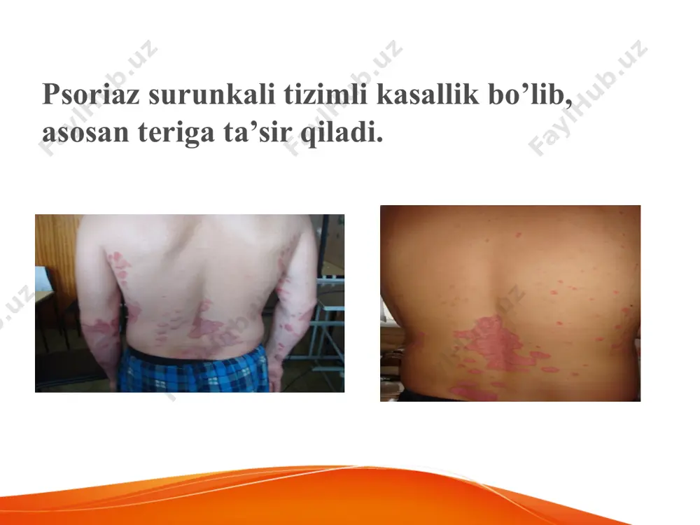 genodermatoz (irsiy teri kasalliklari) - Page 5