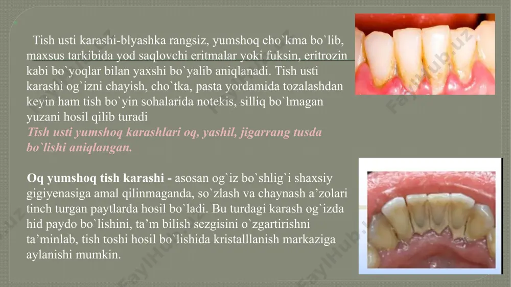 aniqlanadi, agar bo‘lmasa, demak toshlar yo‘q hisoblanadi. milk usti va osti tish toshlarini fizik usulida tozalash ultratovush apparati yordamida tozalash («ultradent», «cavitron selekt». bajariladigan bosqichlar qadamlar: 1. ultradent apparatini yqish va suvga ulanganini tekshirish 2. tozalash vaqtida dastakni tish o‘qiga burchak ostida ushlanadi 3. yuqori jag‘ning chap tarafidan avval vestibulyar yuzadan, so‘ng oral yuzadan tish toshlari olinadi 4. pastki jag‘ning o‘ng tarafidan avval vestibulyar yuzadan, so‘ng oral yuzadan tish toshlari olinadi air flow apparati bilan tozalash air flow gigienik tishlarni tozalash - bu qurilma suv, havo va maxsus kukun kristallari aralashmasini bosim ostida tishlarga purkaydigan apparat. bunda bosimning darajasi stomatolog tomonidan tanlanadi. ushbu qurilma yordamida milk usti va milk osti toshlari ham oson olib tashlanadi. bu emalga zarar bermaydigan professional tozalashning xavfsiz va og'riqsiz usuli. uni qo'llashdan keyin tishlar engilroq bo'ladi. bemorga ko'proq qulaylik yaratish uchun mevali xushbo'y kukun ishlatiladi. image2.jpeg image3.jpeg image4.png image5.png image6.png image7.png image8.png image9.png image10.png image11.png …
