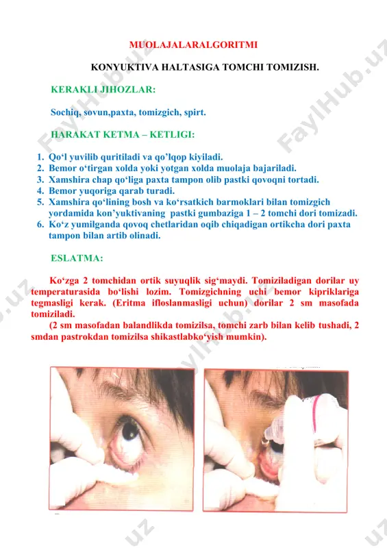 robirkani gorizontal chiziq bo‘yicha o‘z tirkishidagi chakka terisiga taqab qo‘yiladi. 3. zuluk yopishib olmaguncha tik holda ushlab turiladi. 4. keyin probirkaga olib qo‘yiladi. 5. chakkaga ko‘pibilan 2 ta zuluk qo‘yish tavsiya etiladi. 6. 36 – 60 minutn o‘tgach, zuluk o‘zi tushib ketmasa, ustiga gipertonik natriy xlor eritmasi yoki tuz sepish kerak. 7. chakka bir necha kunga qattiq qilib bog‘lab qo‘yiladi. eslatma: zulukni vena yoki arteriya ustiga qo‘yib bo‘lmaydi. chakkaga ko‘pi bilan 2 tazuluk qo‘yish mumkin. muolajalaralgoritmi ko‘z yo‘llarini zondlash. kerakli jihozlar: 0,25 – 0,5% lidikain, paxta, lotok, 5 grshprits, zondlar, 1:5000 furatsillin eritmasi, stul. harakat ketma – ketligi: 1. muolaja stulda o‘tirgan holatda bajariladi. 2. kon’yunktiva 0,25 – 0,5% li dikain eritmasi tomiziladi. 3. pastki ko‘z yosh nuqtasidan ingichka zond bilan kengaytiriladi. 4. zondning pastki ko‘z yosh nuqtasidan oldin vertikal, so‘ngra gorizontal yo‘nalishida burun suyagiga qadab yotqiziladi. 5. ko‘z yosh xaltasi va ko‘z yosh burun yo‘li orqali zond burunga kiritiladi. …