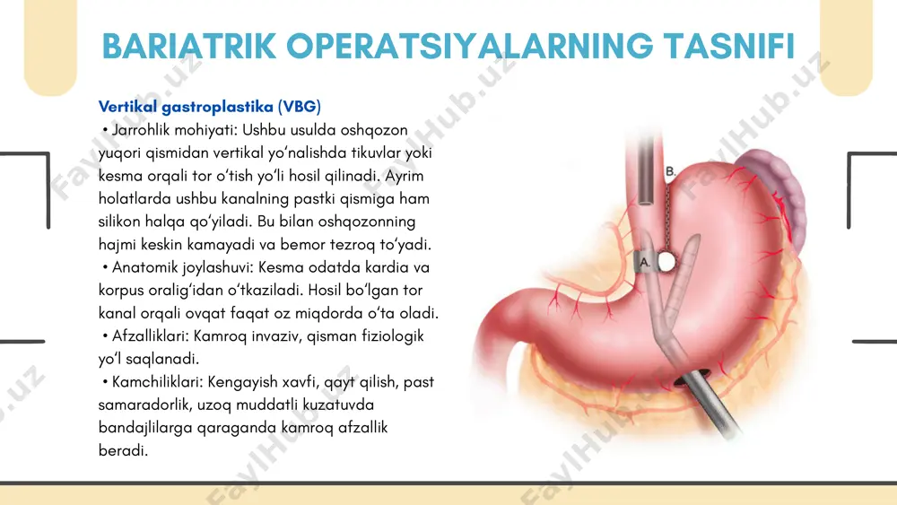 minimal darajada. • operatsiyadan keyingi infeksiya xavfining pasayishi. laparoskopik yondashuvda trokarlar joylashuvi anatomik markerlar asosida belgilanadi: umbilikus, linea alba, qovurg‘a osti yoylari va spigel chizig‘i bo‘ylab. peritoneal kavitada harakat erkinligi va anatomik strukturalarning yaqqol ko‘rinishi laparoskopik jarrohlikning muvaffaqiyatini ta’minlaydi. zamonaviy texnologiyalar va yondashuvlar bariatrik jarrohlikda metabolik jarrohlik so‘nggi yillarda semizlikni metabolik sindrom bilan bog‘liq kasalliklar – xususan, 2-tip qandli diabet, dislipidemiya, insulin rezistentlik kabi kasalliklar bilan birga davolashga qaratilgan yangi yo‘nalish rivojlandi. bu — metabolik jarrohlik deb ataladi. metabolik jarrohlikning asosiy maqsadi – nafaqat ovqat hajmini kamaytirish yoki kaloriya so‘rilishini to‘xtatish, balki endokrin tizimga ham bevosita ta’sir o‘tkazish orqali organizmning metabolik holatini optimallashtirishdir. ko‘p ishlatiladigan operatsiyalar: • duodenojejunal bypass – duodenum chetlab o‘tiladi, insulin sezuvchanligi ortadi. • ileal interpozitsiya – ileumning distal qismini oldinga ko‘chirish orqali inkretin gormonlar (glp-1, pyy) faollashadi. • sleeve gastrektomiya metabolik samarasi tufayli nafaqat semizlik, balki qandli diabetni ham nazorat ostiga olish imkonini beradi. klinik ahamiyati: …