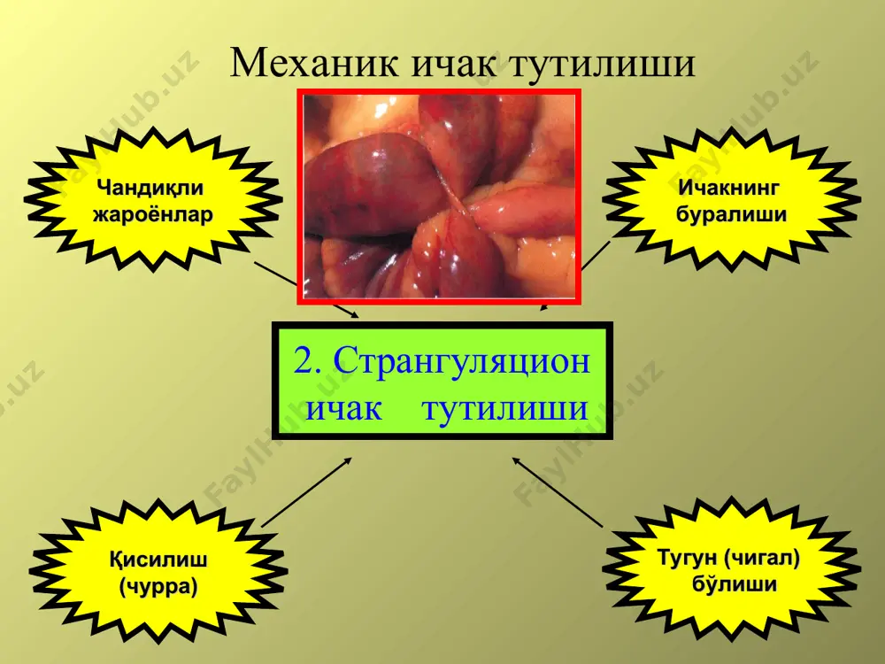 ўткир ичак тутилиши - Page 5