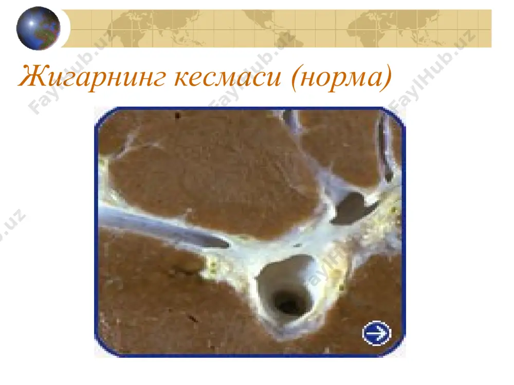 йўқотиш лозим. пархез таомлар оқсилга, витаминларга, углеводларга бой бўлиши керак, мол ёғи чегараланади, қисман ўсимлик ёғи билан алмаштирилади. етарли миқдордаги оқсил регенерация жараёнини, жигарнинг ёғ дегенерацияси олдини олади, ўт ажралишини кучайтиради. а. сурункали фаол ва люпоидли гепатитни дори-дармонлар билан даволаш: (1) жигар хужайраларида модда алмашинувини яхшиловчи дорилар (гепатопротекторлар): в1, в6, в12, с витаминлари, липоид кислотаси ёки липамид. (2) некрозни тўхтатиш, регенерацияни кучайтириш, липотроп таъсир ўтказиш мақсадида аминокислоталар (глютамин кислотаси), оқсил гидролизатлари (аминопептид, албумин, аминокровин) венага томчилаб юборилади. (3) яллиґланишга қарши ва иммун тизими фаолиятини яхшилаш учун: глюкокортикоидлар, аминохинолин хосилалари (делагил, плекванил), цитостатиклар, сурункали холестатик гепатитда асосий диққат холестаз сабабини аниклашга ва йўқотишга каратилиши керак. тери кичишида холестирамин, гистамин антогонистлари (супрастин, пиполфен, диазолин, тавегил, кларетин) қабул қилинади. б. физиотерапия. в. халљ табобати. 12. профилактикаси - вирусли ўткир гепатитнинг олдини олиш, алкогол истеъмолига чек қўйиш, ўткир гепатитни сифатли даволаш, турмушда ва ишлаб чиљаришда заҳарланишга барҳам бериш. актив гепатитда преднизолон холестатик гепатитда холестерамин …