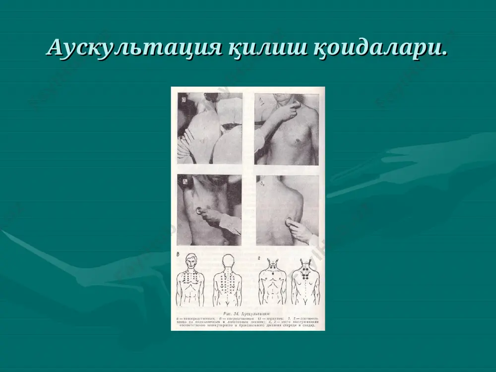 , «х» харфининг талаффузини эслатади хикилдоктрахея, бифуркация нафас чикаришда узунрок, дагалрок эшитилади нормал патологик: 1.кукрак кафаси устида 2.амфорик 3. металлик везикуляр ва бронхиал нафасни эшитиш сохалари бронхиал нафас везикуляр нафас амфорик нафас 1. хаволи бушликниг мавжудлиги 2. бушликнинг бронх билан туташганлиги 3. бушликннг диаметри (≥ 5-7 см) металлик нафас иккиламчи (қўшимча) нафас шовқинлари хириллашлар крепитация плевра ишқаланиш шовқини хириллашлар пайдо булиш жойи пайдо булиш механизми эшитилиши нафас актига богликлиги узгариши курук хириллашлар бронхлар, трахея хаво окими торайган жойдан утганда товуш беради хуштаксимон, гувилловчи, мусикали ва хок. нафас олишда ва чикаришда эшитилади йуталдан кейин узгармайди нам хириллашлар бронхлар, трахея хаво окими суюкликдан утганда пуфаклар хосил булади ва ёрилади пуфаклар ёрилишининг товуши (майда-, урта-, катта пуфакли) нафас олишда ва чикаришда эшитилади йуталдан кейин узгаради хириллашлар (ronchi) - қўшимча нафас шовқинлари трахея, бронхлар ва улар билан алоқада бўлган бўшлиқларда ёт массаларнинг (балғам, экссудат, транссудат, йиринг, қон ва бошқ.) ҳаракатланиши натижасида келиб чиқади. ҳаво …