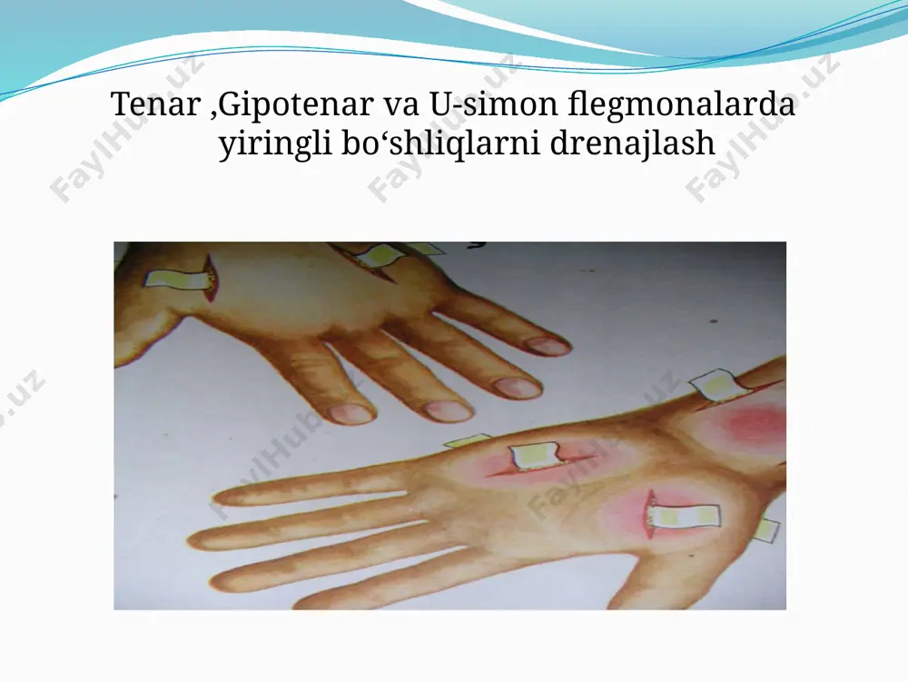 kaft barmoqlar xirurgik infeksiyasi: kaft flegmonasi va panaritsiy - Page 5