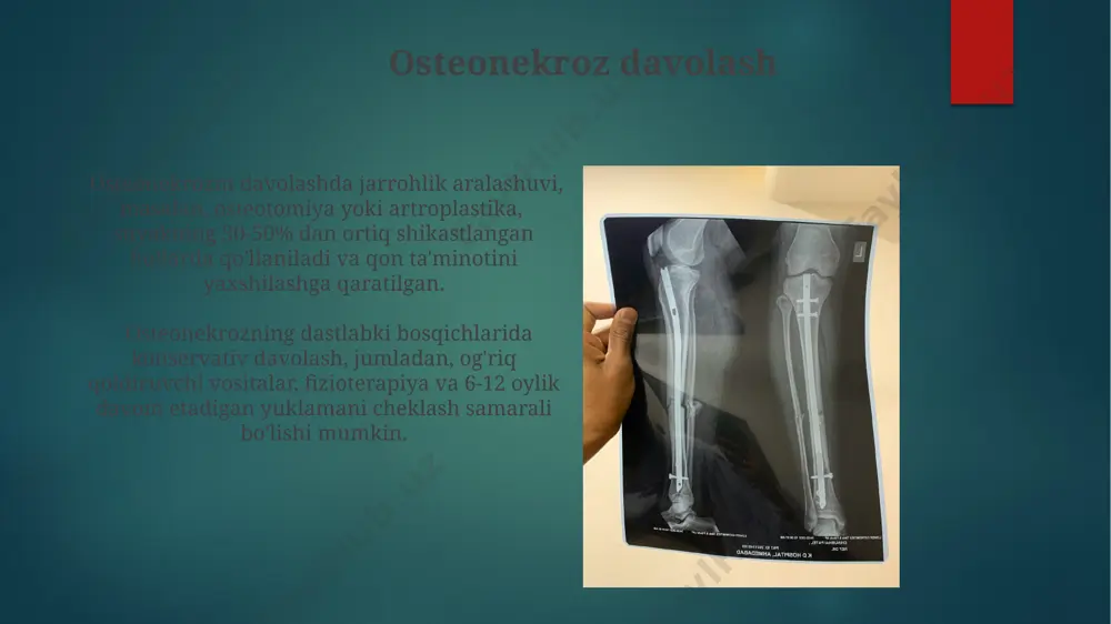 chik suyaklarning va qo'shimchalar yaqinidagi sinishlarni batafsil tasvirlash imkonini beradi, bu 3d tasvirlarni hosil qilish orqali 95% aniqlikni ta'minlaydi. fraktura davolash suyak singan joyni to'g'rilash uchun tashqi fiksatsiya usuli, masalan, ilizarov apparati yordamida, 2-3 oy davomida suyakning to'liq bitishini ta'minlaydi, bu esa 90% muvaffaqiyat ko'rsatkichiga ega. kompressio osteosintez jarrohlik amaliyoti, suyak parchalarini maxsus vintlar va plastinkalar yordamida bir-biriga mahkam bog'lashni o'z ichiga oladi, bu esa 6-8 hafta ichida suyak bitishini tezlashtiradi. suyak rivojlanishining genetik buzilishlari osteogenesis imperfecta, 1 dan 8 gacha bo'lgan turli xil turlarga ega bo'lib, kolagen geni mutatsiyalari tufayli suyaklarning haddan tashqari mo'rtligini keltirib chiqaradi. achondroplasia, fgfr3 genidagi mutatsiyalar natijasida kelib chiqadi va o'rtacha 80% hollarda o'sishning sezilarli darajada buzilishiga olib keladi. fraktura klinikasi konservativ davolashda gips, shina yoki boshqa immobilizatsiya vositalari 6-8 hafta davomida qo'llaniladi, bu esa suyakning to'liq bitishini ta'minlaydi. diagnostika jarayonida rentgenografiya, kt va mrt kabi tasviriy diagnostika usullari qo'llaniladi, bu esa sinishning aniq lokalizatsiyasi …