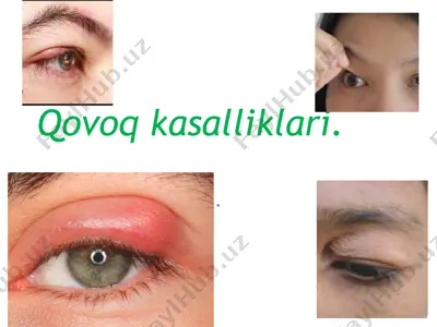 qovoq kasalliklari — PPTX