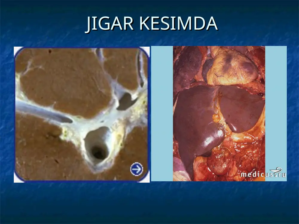 ) 1.morfologiyasiga ko'ra : a. surunkali gepatit b. portal traktda fibroz bo'lishi v. jigar bo'lakchasining periportal zonasida fibroz bo'lishi g. jigar bo'lakchasining hamma qismida d. jigar sirroz 2. kompensasiyalanganligiga ko'ra : a. kompensasiyalangan b. dekompensasiyalangan 3. faolligiga ko'ra: a. nofaol faza b. faol faza bu tasnifga ko'ra surunkali gepatit va jigar sirrozi bir hil kasallik. 5 bosqichi aniqlanadi. bu bosqichlar faqat punksiyali biopsiya yordamida aniqlanishi mumkin. * klinikasi bir qator sindromlar farqlanadi. 1.og’riq sindromi o’ng qovurg’a, epigastral sohada og’riq, uning ovqatdan keyin kuchayishi og’riq jigar kapsulasining cho’zilishi va jigarning kattalashishi tufayli kelib chiqadi og’riq pankreatit, xoletsistit, o’t yo’llari diskineziyasi tufayli ham yuzaga keladi 2. dispeptik sindrom ko’ngil aynish qayt qilish qorinning dam bo’lishi og’izda achchiq ta’m sezish 3.astenonevrotik sindrom tez charchash ish qobiliyatining pasayishi asabiylashish uyquning buzilishi 4.xolestaz sindromi teri va skleraning sarg’ayishi, terining qichishi- jigar ichi xolestazi yoki nekrotik o’zgarishlar tufayli va qonda bog’langan bibirubin oshishi 5.portal gipertenziya sindromi …