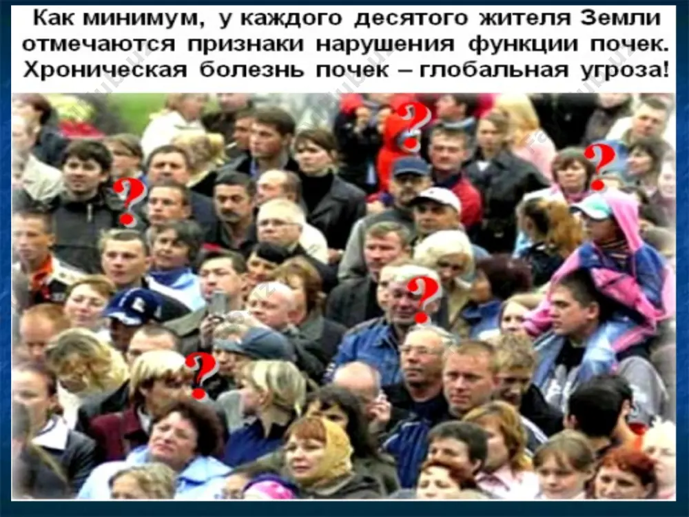 йдик – тош касаллиги, гидронефроз, сийдик йўллари ўсмалари) этиологияси (давоми) этиологияси (давоми) сбк нинг этиялогияси жуда кўп, аммо, энг кўп сабабчилари бўлиб, гломерулонефрит, пиелонефрит ва бошқа этиологиялик интерстциал нефритлар ҳисобланади. сбк нинг ривожланишида қайси этиологиядан қатъий назар морфологик ўзгаришлар бир хил бўлиб, гломерулосклероз, интерстциал фиброз, сақланган нефронларнинг гипертрофияси билан кечади. коптокчалар ичидаги гемодинамик ўзгаришлар гипертензияда намоён бўлиб, у коптокчалар артериолалари тонусининг пасайиши ва резервдаги буйраклар функциясининг йўқолиши туфайли рўй беради. сурункали буйрак касаллигининг этиологияси сбкнинг хавф омиллари 1. модификацияланмайдиган омиллар ёш эркаклар ирқ нефронларнинг туғма кам бўлиши генетик омиллар 2. модификацияланувчи -патологик жараённинг қайта қайта фаоллашиши -протенурия/микроальбуминурия -системали аг -юқори оқсилли диета -дислипопротеидемия сбкнинг хавф омиллари симпатик нерв тизими фаоллигини ошиши анемия чекиш гипергликемия метаболик ацидоз гиперпаратиреоз сурункали яллиғланишлар ёндош омиллар: инфекция, сийдик йўллари обструкцияси, семизлик хомиладорлик ятроген омиллар сбк классификацияси сбк 3 ой ва ундан ортиқ давр ичида кфтнинг 60 мл/мин/1,73 кв. мдан кам бўлиши билан характерланади бунда буйрак …