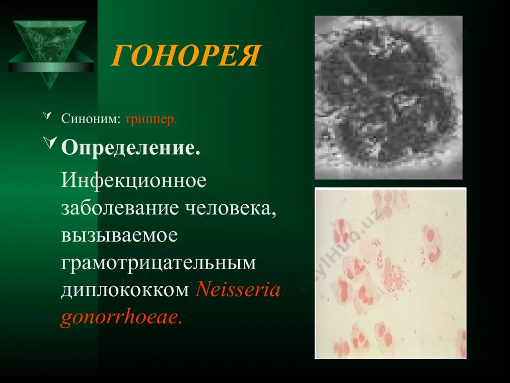 uskanie, videleniya, chashe gnoynogo xaraktera, iz uretri i/ili vlagalisha. pri oslojnyonnoy gonoree v vospalitelniy protsess vmeste s vnepolovimi organami vovlekayutsya drugie organi malogo taza, chto soprovojdaetsya bolyami v jivote, simptomami intoksikatsii, narusheniem menstrualnogo tsikla. klinicheskaya kartina gonoreynoy infektsii u mujchin mojet vklyuchat simptomi uretrita, tsistita, epididimita, orxita, prostatita, balanopostita, littreita, kuperita, vezikulita, pielonefrita. jalobi zavisyat ot xaraktera i stepeni tyajesti vospalitelnogo protsessa i svyazani s dizuriey, gnoynimi videleniyami iz mocheispuskatelnogo kanala, bolyami v promejnosti s irradiatsiey v oblast pryamoy kishki, narusheniyami erektsii i orgazma. gonoreya gonoreyniy uretrit, oslojnyonniy balanitom (gnoynie kremopodobnie videleniya iz narujnogo otverstiya uretri, giperemiya i melkotochechnie uzelkovie elementi golovki polovogo chlena). gonoreya klinicheskie proyavleniya gonorei u jenshin mogut vklyuchat simptomi uretrita, tservitsita, vulvita, vaginita, vulvovaginita, tsistita, patsientki pred'yavlyayut jalobi na dizuriyu, vaginalnie videleniya gnoynogo xaraktera, zud, jjenie, diskomfort v oblasti narujnix polovix organov, boleznennost polovix aktov, boli v jivote, narusheniya menstrualnogo tsikla, povishenie temperaturi. gonoreynoe porajenie drugix …