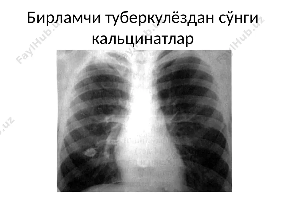 tuberkulez infiltrlatsiya davri - Page 3