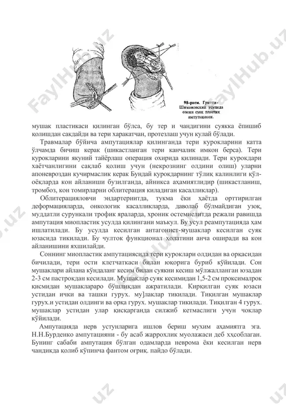 ormatsiyalarda, onkologik kasalliklarda, davolab bo'lmaydigan uzoq, muddatli surunkali trofik yaralarda, xronik ostemielitda rejali ravishda amputatsiya mioplastik usulda qilingani ma'kul. bu usul reamputatsiyada ham ishlatiladi. bu usulda kesilgan antagonist-mushaklar kesilgan suyak yuzasida tikiladi. bu chultok funktsional holatini ancha oshiradi va kon aylanishini yaxshilaydi. sonning mioplastik amputatsiyasida teri kuroklari oldidan va orqasidan bichiladi, teri osti kletchatkasi bilan yuqoriga burib ko'yiladi. son mushaklari aylana ko'ndalang kesim bilan suyakni kesish mo'ljallangan yuzadan 2-3 sm pastrokdan kesiladi. mushaklar suyak kesimidan 1,5-2 sm proksimalrok qismidan mushaklararo bo'shliqdan ajratiladi. kirqilgan suyak yuzasi ustidan ichki va tashki gurux. mu]laklar tikiladi. tiqilgan mushaklar gurux.i ustidan oldingi va orqa gurux. mushaklar tikiladi. tiqilgan 4 gurux. mushaklar ustidan ular qisqarganda siljib ketmasligi uchun choklar ko'yiladi. amputatsiyada nerv ustunlariga ishlov berish muxim ahamiyatga ega. n.n.burdenko amputatsiyani - bu asab jarroxlik muolajasi deb xhsoblagan. buning sababi amputatsiya bo'lgan odamlarda nevroma yoki kesilgan nerv chandikda qolib ko'pincha fantom og'riq. paydo bo'ladi. xozirgi paytda nervni …