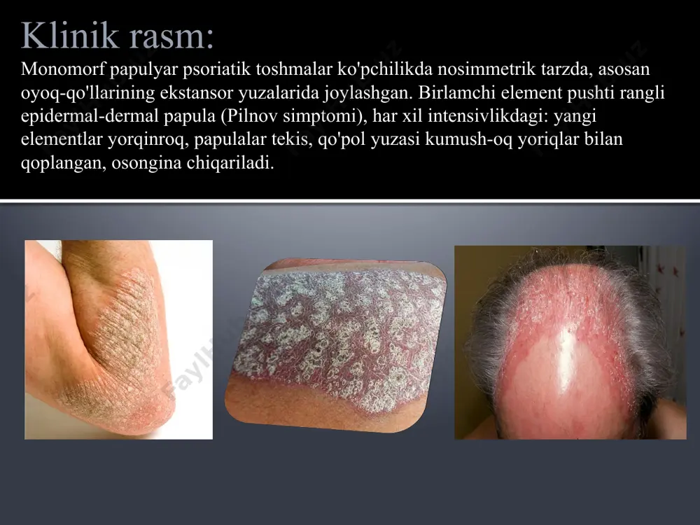 davosi birinchi navbatda, kasallikni keltirib chiqaruvchi omillarni bartaraf etish, infeksiya oʻchoqlarini sanatsiya qilishdan iborat; fizioterapiya, gipnoz bilan davolash, tuzalinqiragan (remissiya) davrida chimyon, chortoq va boshqalar sanatoriylarda davolanish yaxshi naf beradi. image2.jpeg image3.jpeg image4.jpeg image5.jpeg image6.jpeg image7.jpeg image8.jpeg image9.jpeg image10.jpeg image11.jpeg image12.jpeg image13.jpeg image14.jpeg image15.jpeg /docprops/thumbnail.jpeg
