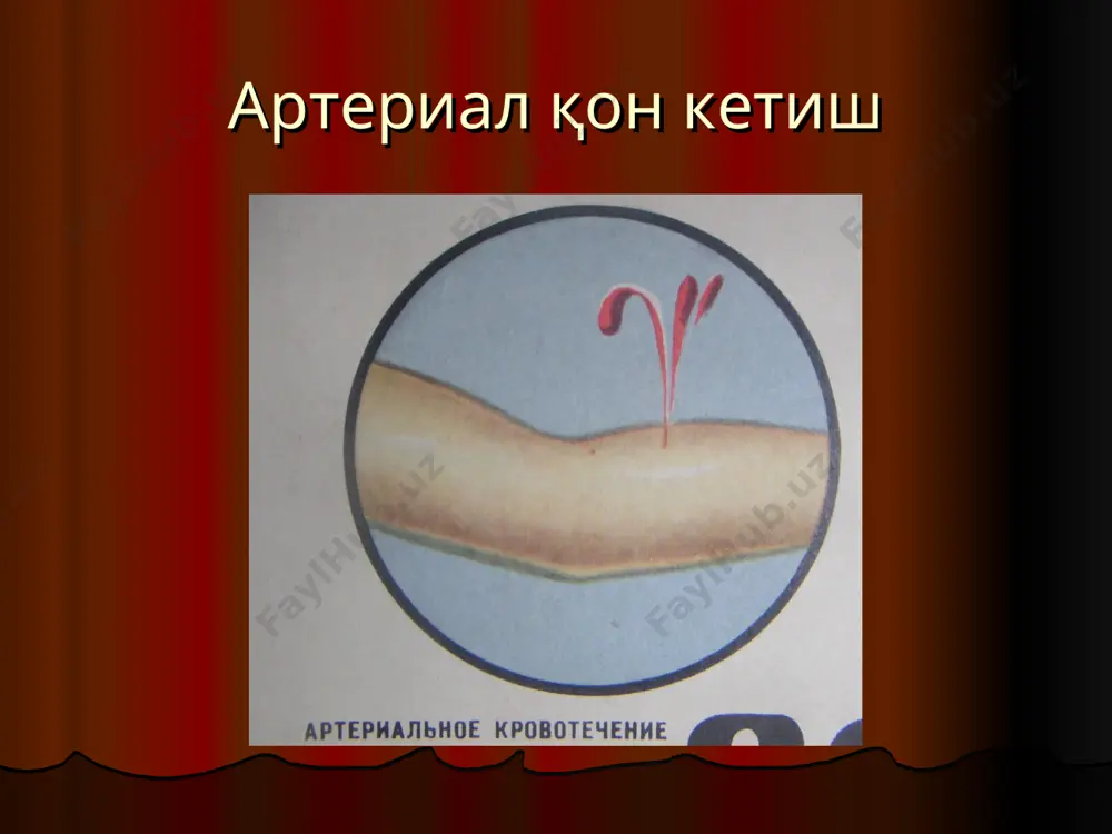 аларни қўллаш/. жарохатдан қон оқиб турган томирга қисқич қўйиш. жгут қўйиш лентасимон жгут артерияларни босиб туриб тўхтатиш учун тегишли нуқталар артерияларни босиб туриб қон тўхтатиш учун анъанавий нуқталар тирсак ёки кафтдан кетаётган қонни тирсак бўғимидан максимал букиб, тўхтатиш оёқни максимал букиш босиб турувчи боғлам қўйиб, қонни тўхтатиш оёқни юқорига кўтариб, кетаётган қонни тўхтатиш қон кетишни батамом тўхтатиш усуллари механик усуллари. термик усуллари. кимёвий усуллари. биологик усуллари. қон кетишни тўхтатишнинг механик усуллари қон томирини жарохатда боғлаш. қон томирини масофадан боғлаш. қон томирига чок қўйиш. босувчи боғлам қўйиш. тампонада. қон томирини қисқич билан ушлаб, боғлаш қон томирини атроф тўқимарга чок қўйиб тикиш билан, кетаётган қонни тўхтатиш қон томирини жарохатда тикиш қон томирини дешан игнаси билан боғлаш қон томирини узоқдан боғлаш қон томирига чок қўйиш қон томирига аппарат ёрдамида чок қўйиш аллотрансплантат ёрдамида қон кетишини тўхтатиш жарохатни тампонада қилиш қон кетишни тўхтатишнинг физик усуллари муз солинган халта ишлатиш қайнок антисептик эритмаси шимдирилган тампон …